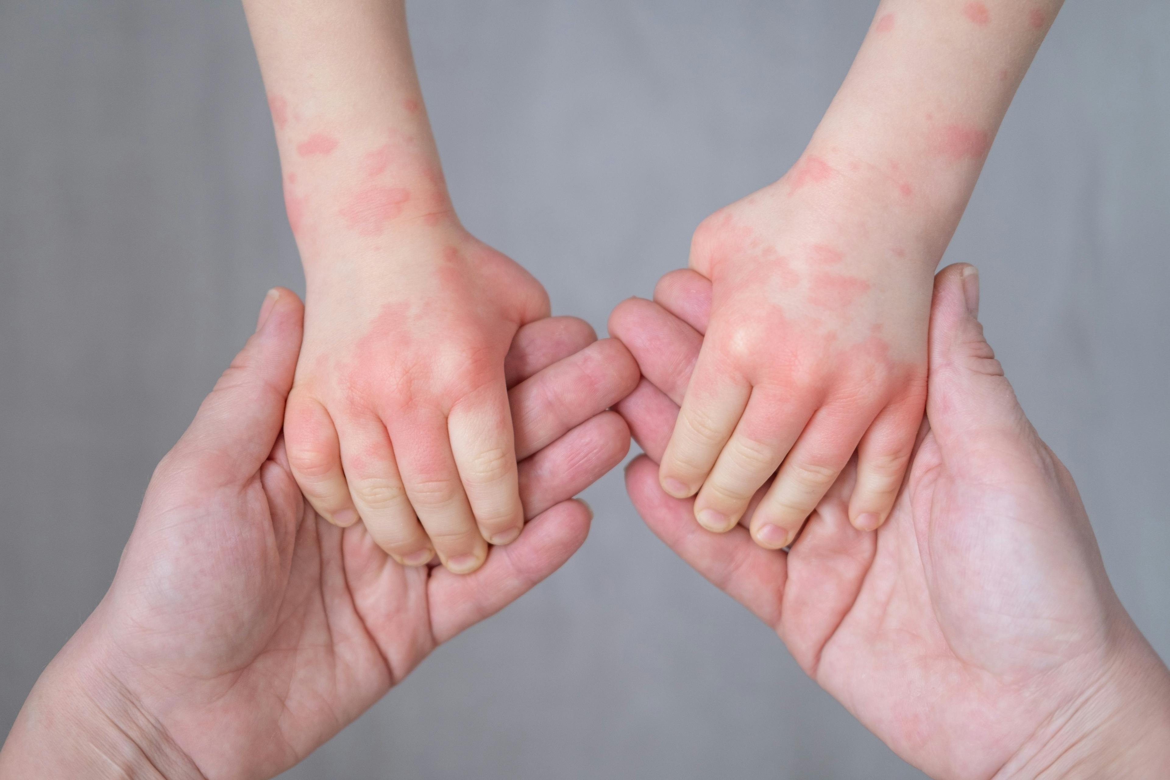 Child with atopic dermatitis (AD) on arms | Image Credit: Юля Шевцова - stock.adobe.com