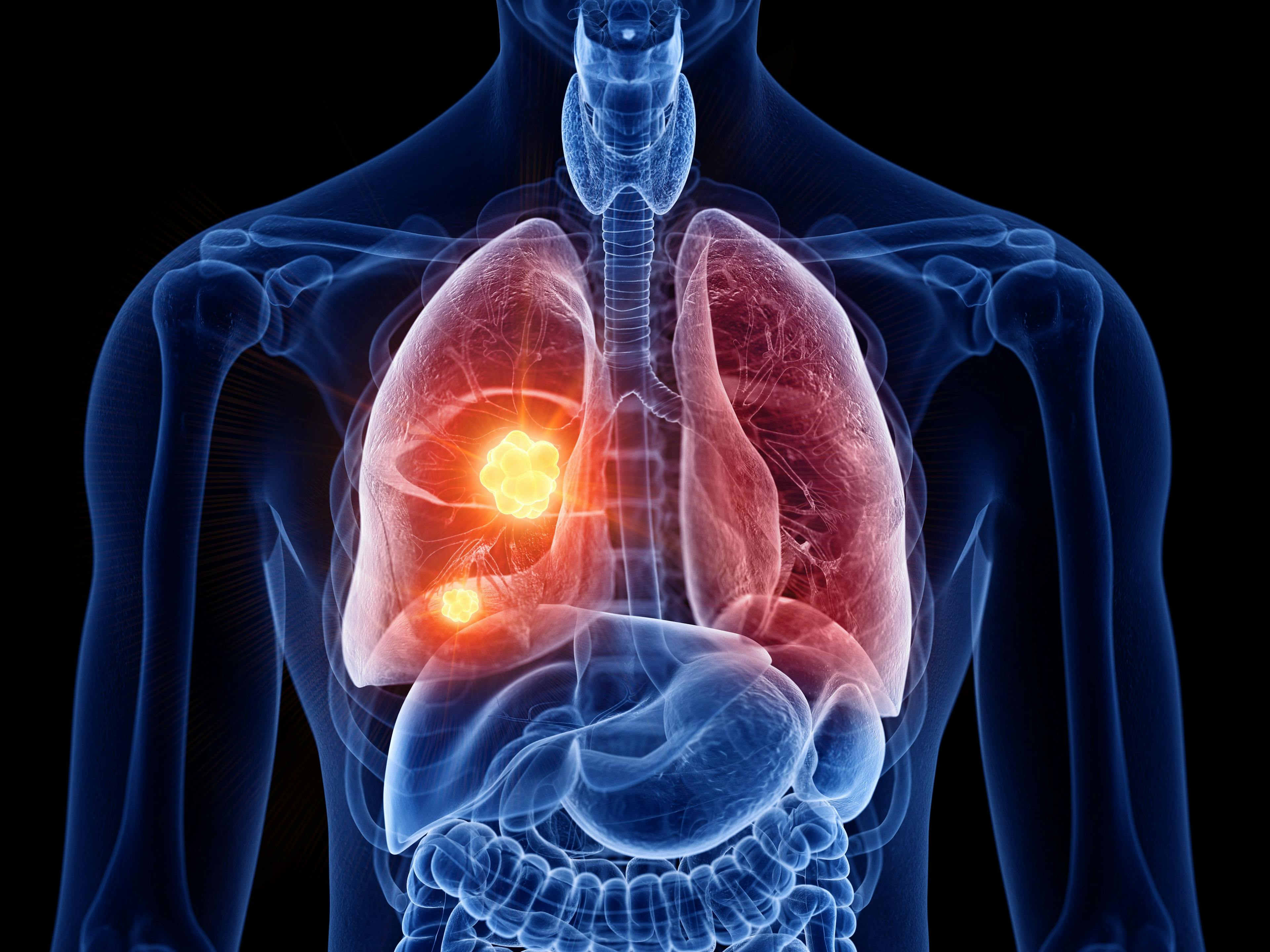 3d rendered medically accurate illustration of lung cancer | Image credit: SciePro - stock.adobe.com