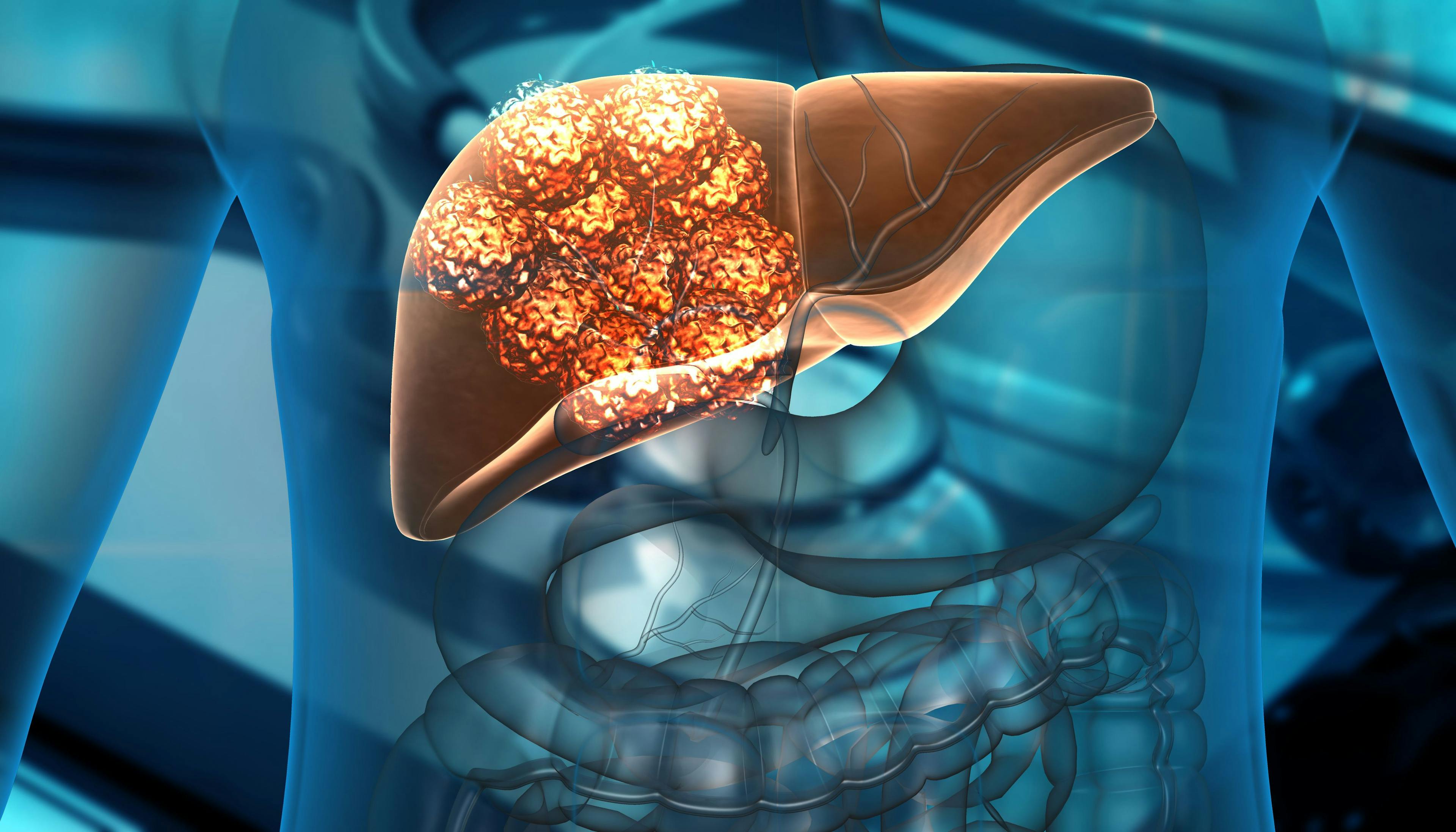 Patient with liver metastases | Image Credit: Rasi - stock.adobe.com