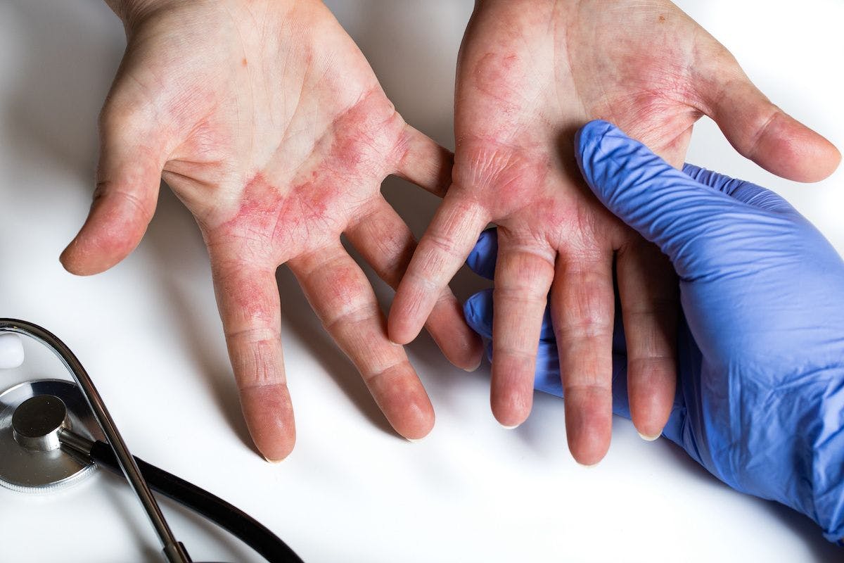 Atopic dermatitis. Red, itchy hands with blisters seen by a dermatologist: © Rochu_2008