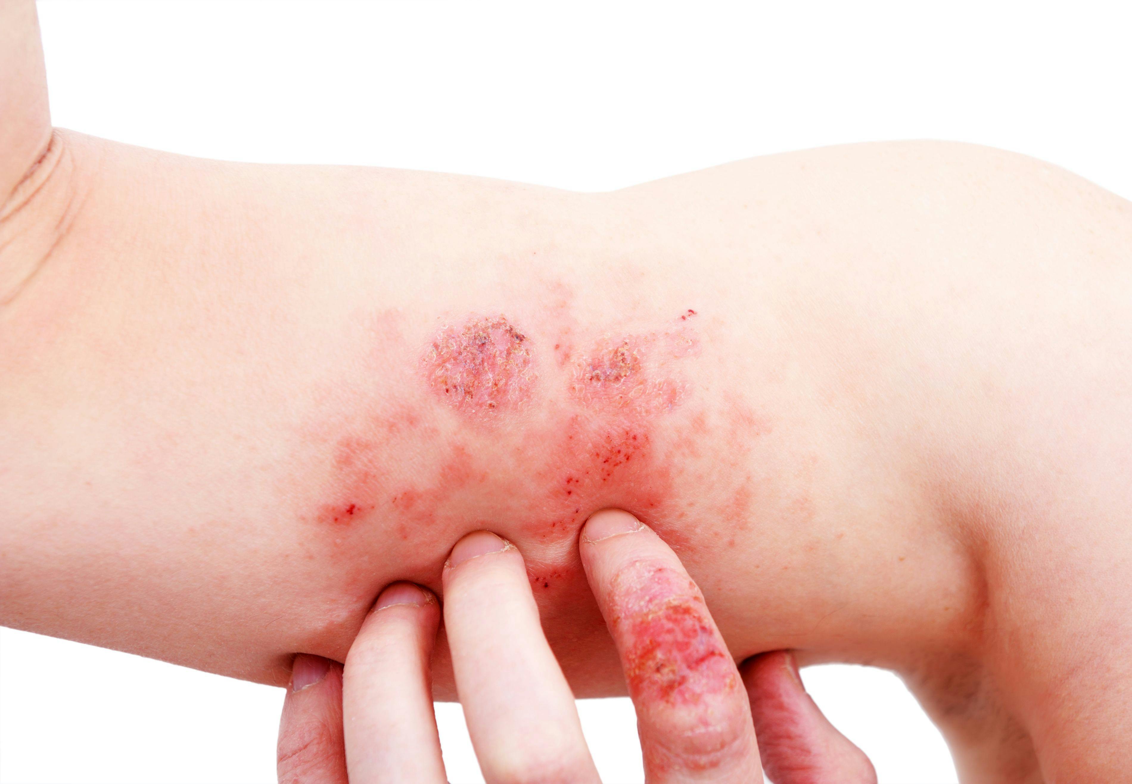 person scratching atopic dermatitis on their arm - Image Credit: lial88 - stock.adobe.com