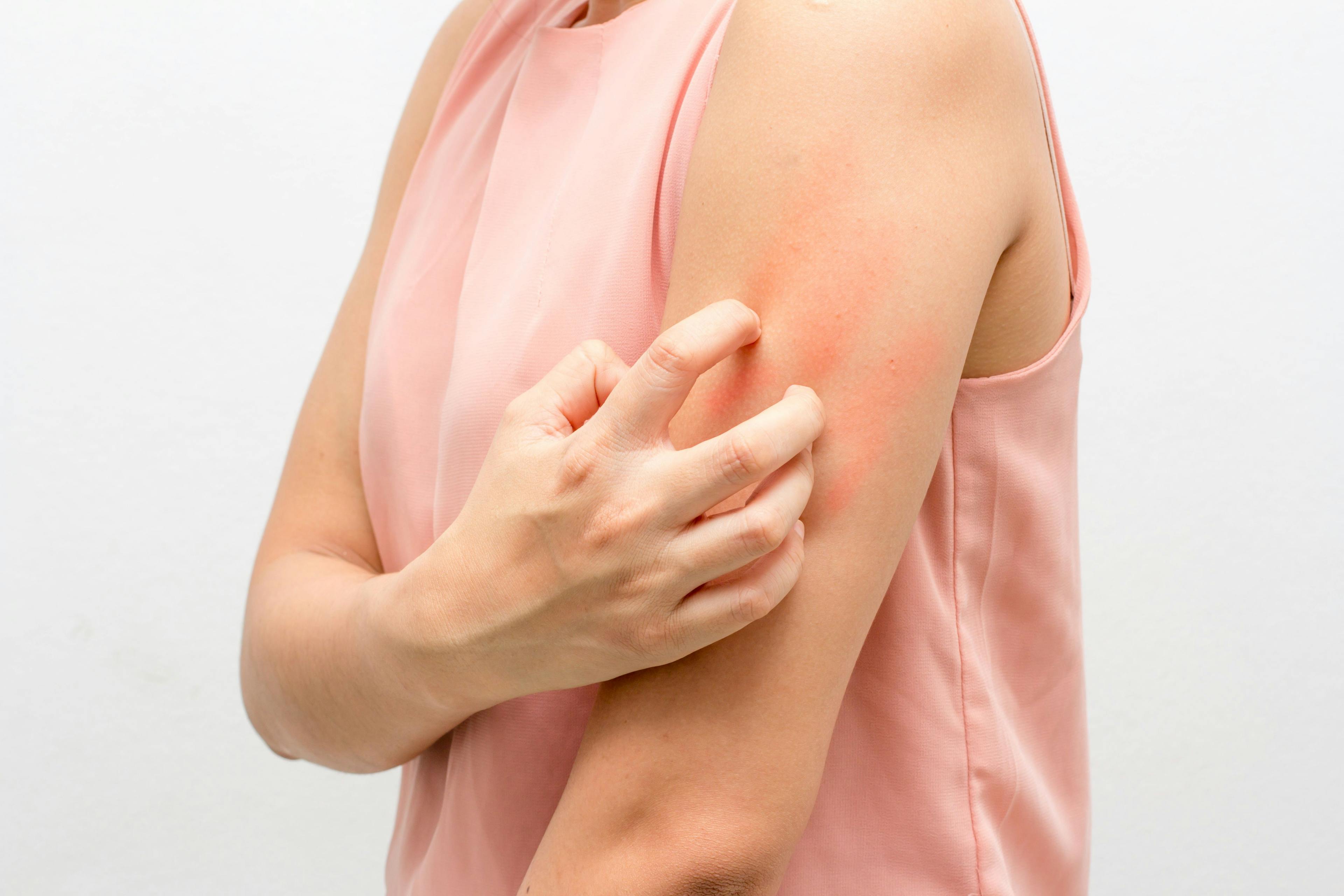 woman scratching atopic dermatitis