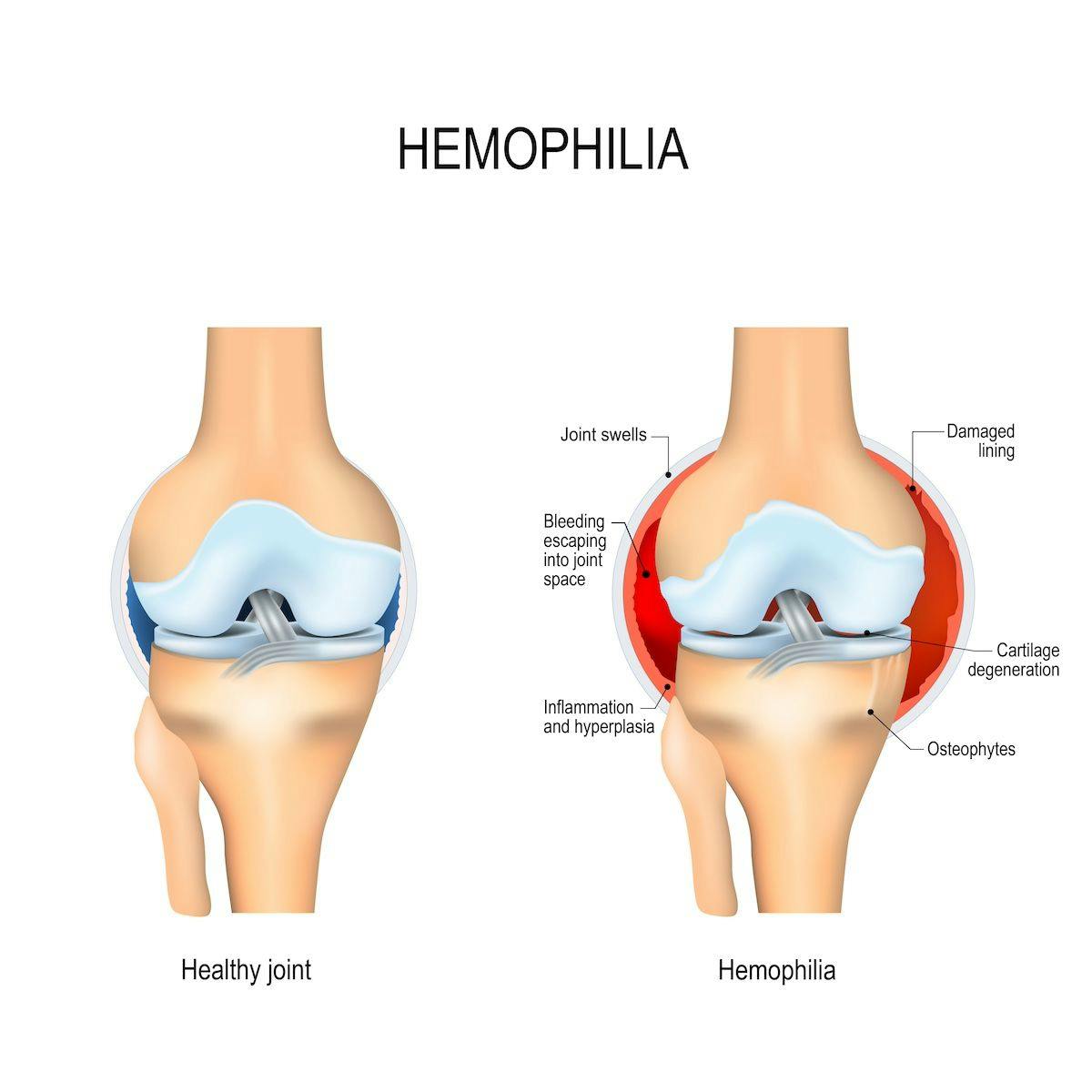 Hemophilia joints | Image Credit: designua - stock.adobe.com