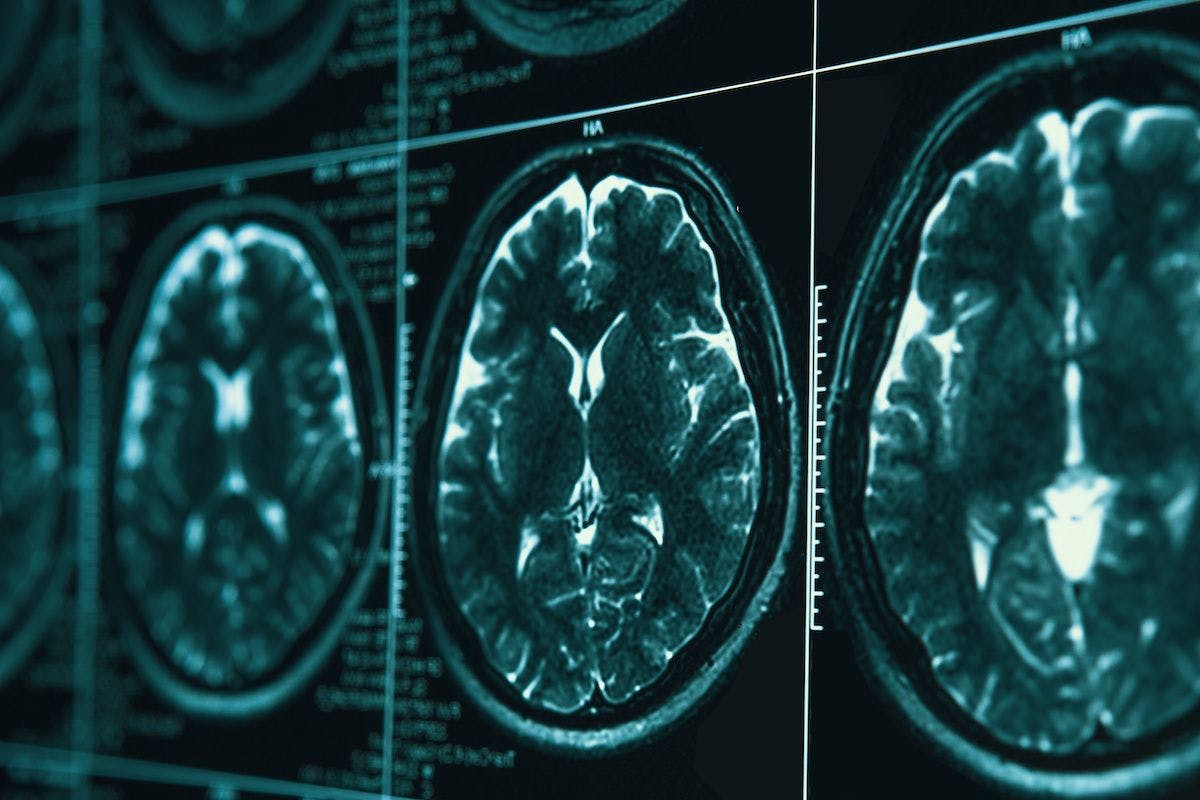 MRI head brain scan | Image Credit: © DedMityay - stock.adobe.com