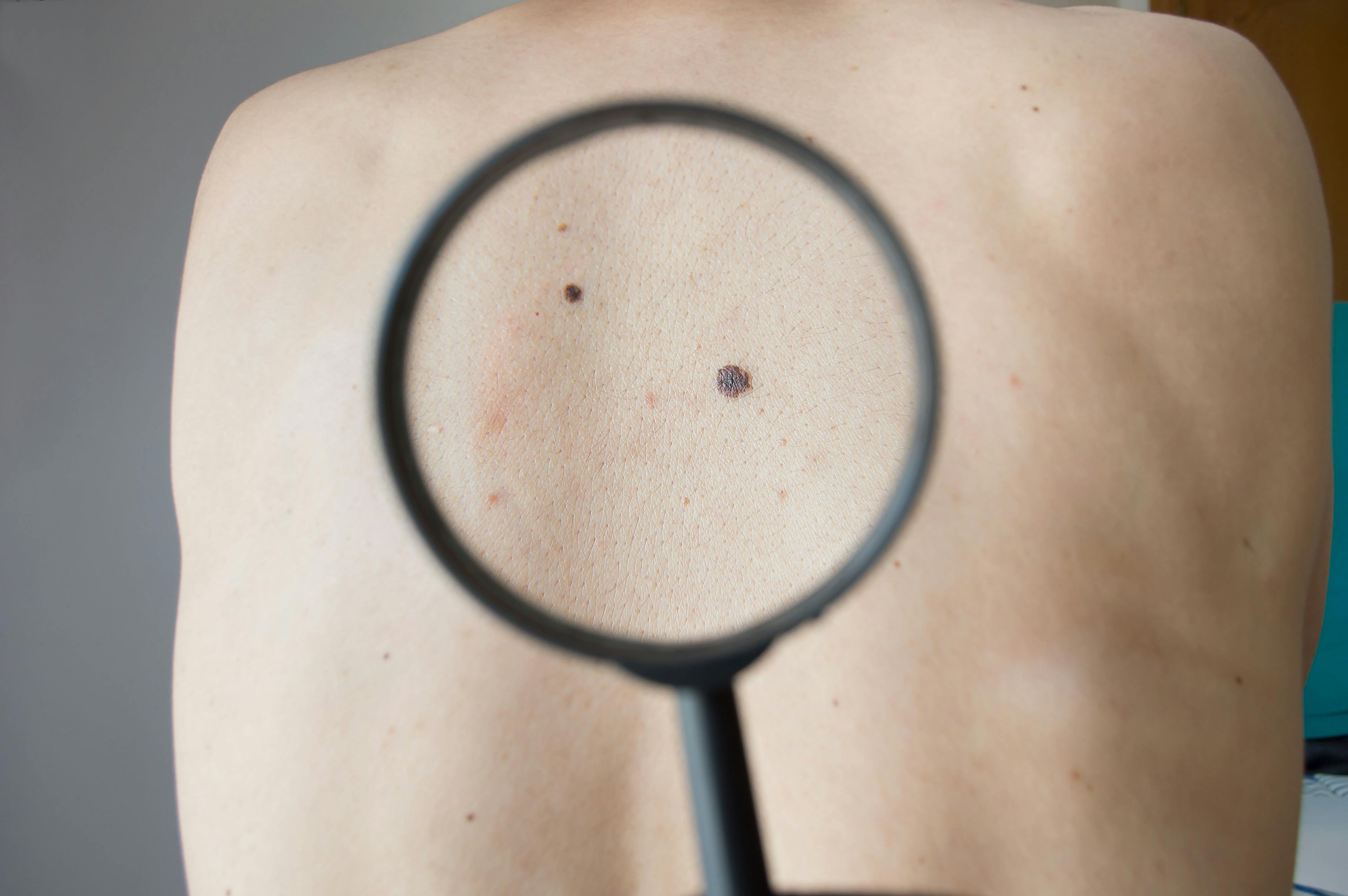 Skin Check for Melanoma | image credit: cunaplus - stock.adobe.com
