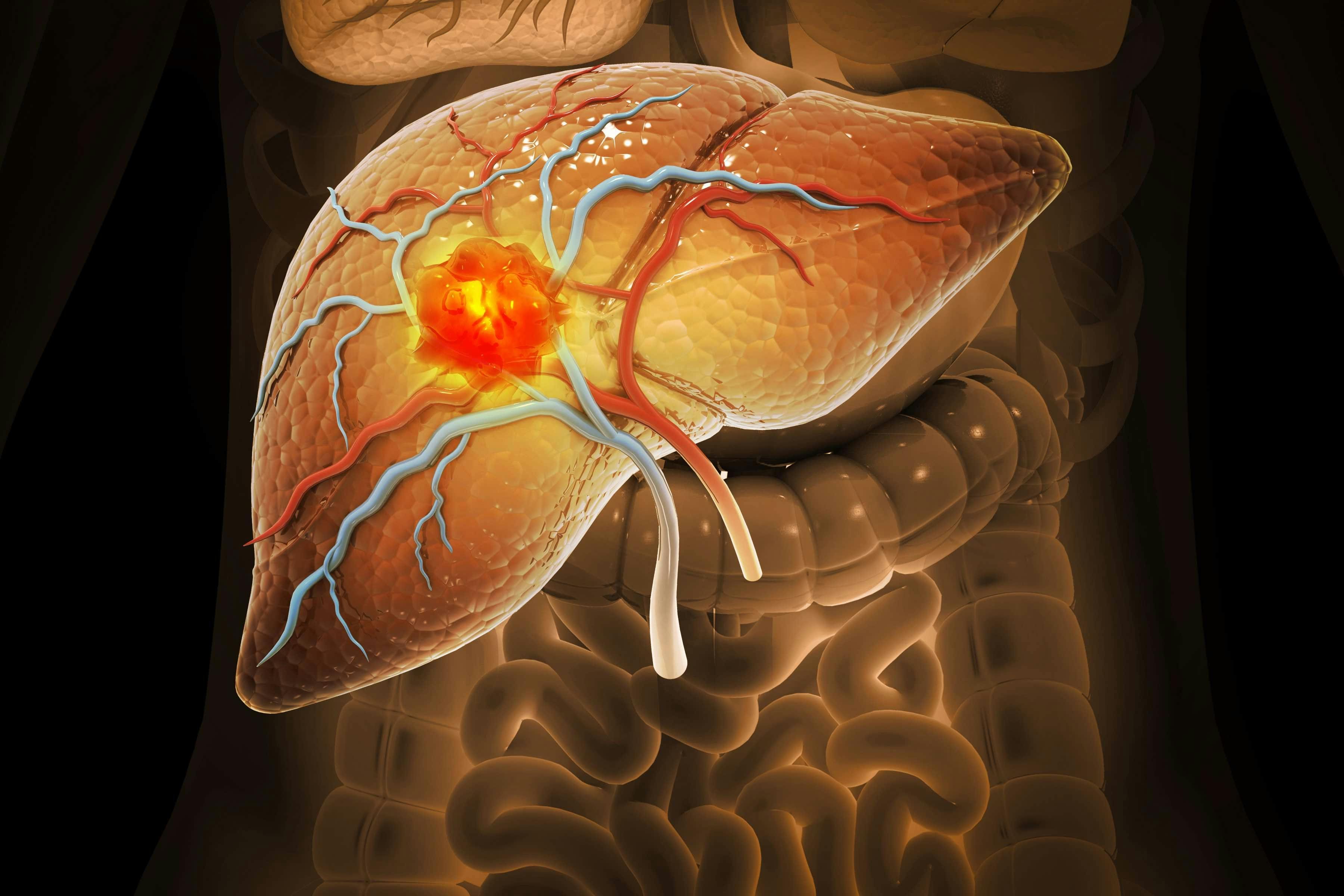 Illustration of hepatocellular carcinoma | Image credit: Crystal light - stock.adobe.com