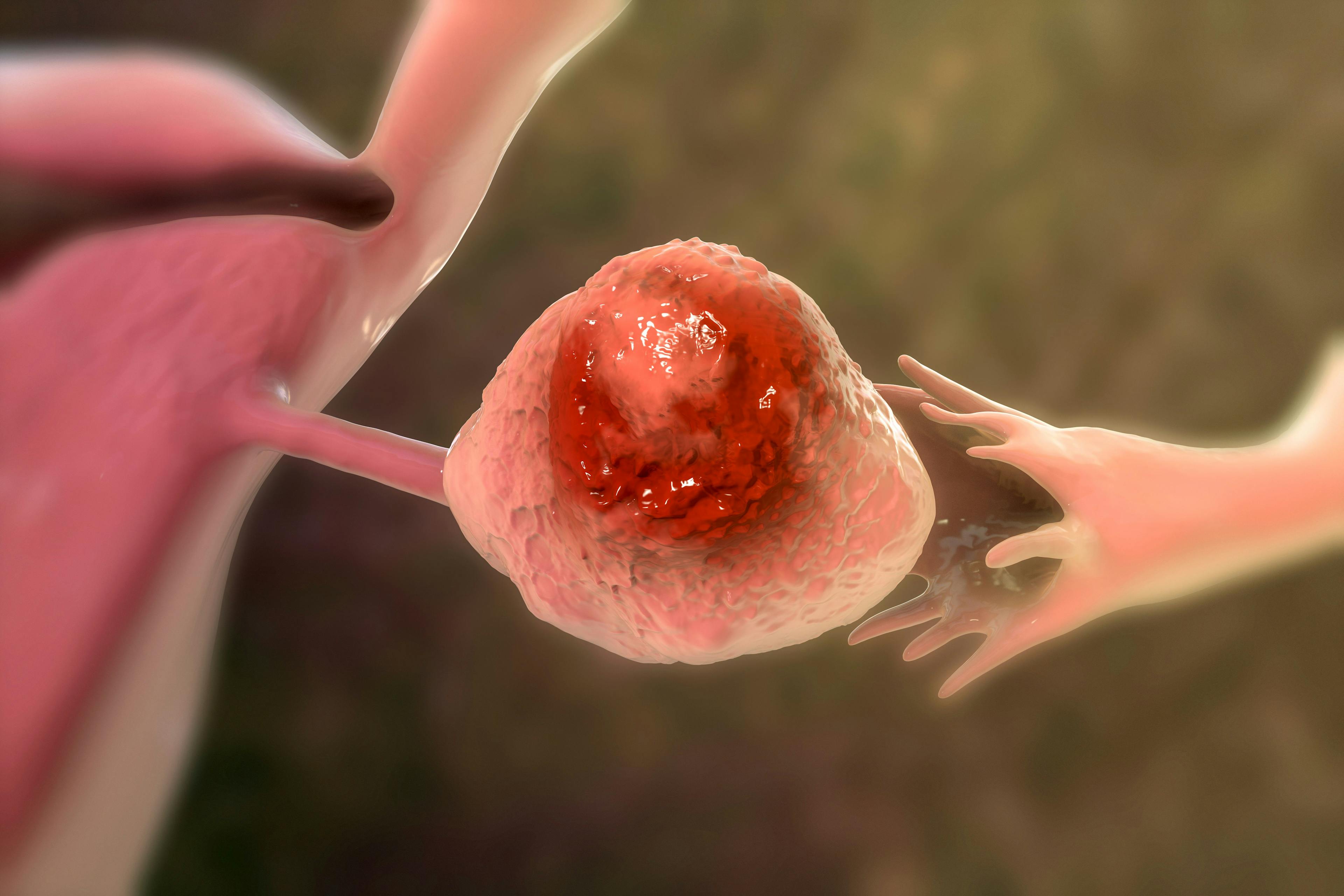 3D illustration of ovarian cancer | Image Credit: Dr_Microbe - stock.adobe.com