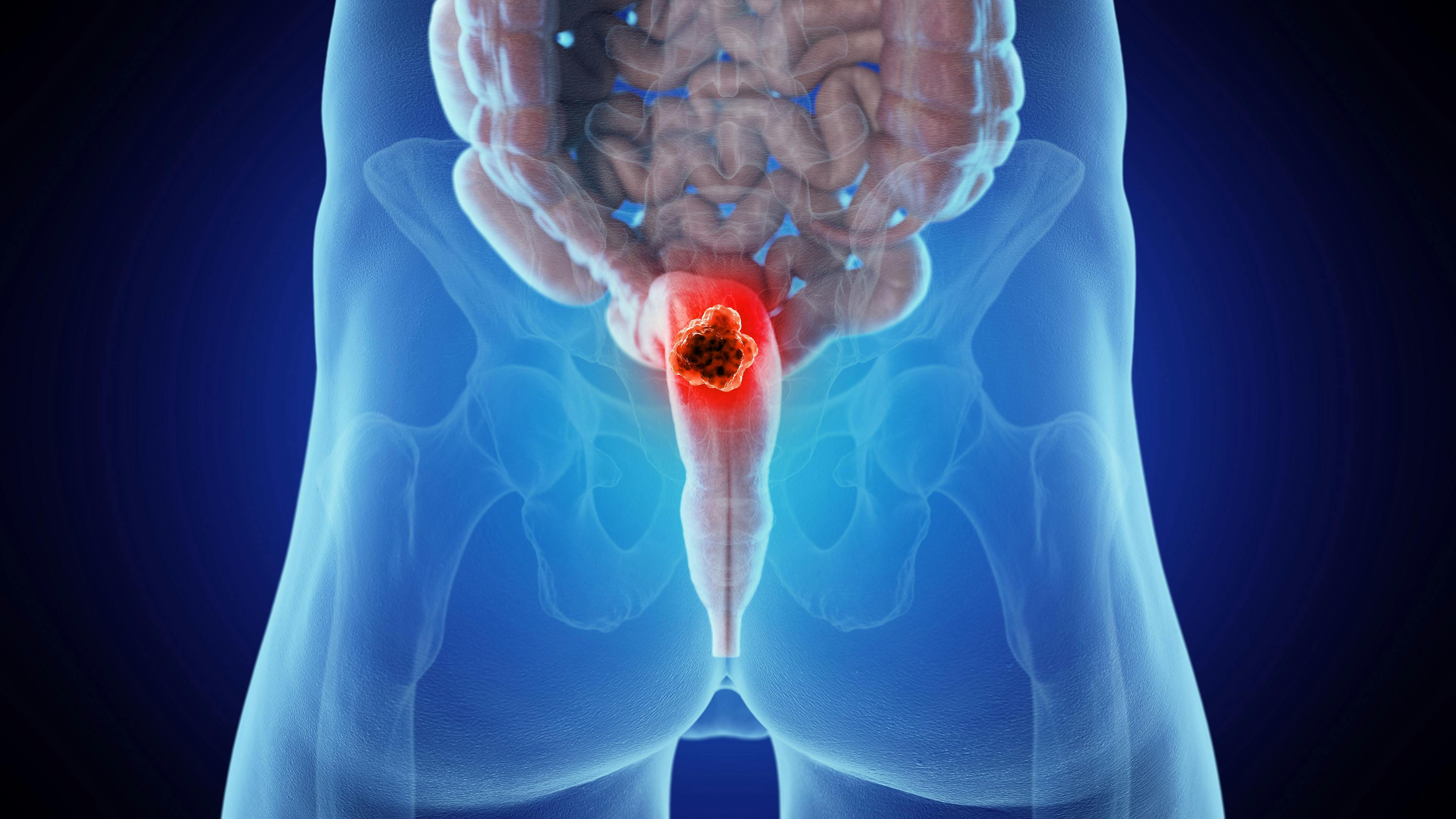 Rectal cancer can be aggressive in younger patients | Image credit: Sebastian Kaulitzki - stock.adobe.com