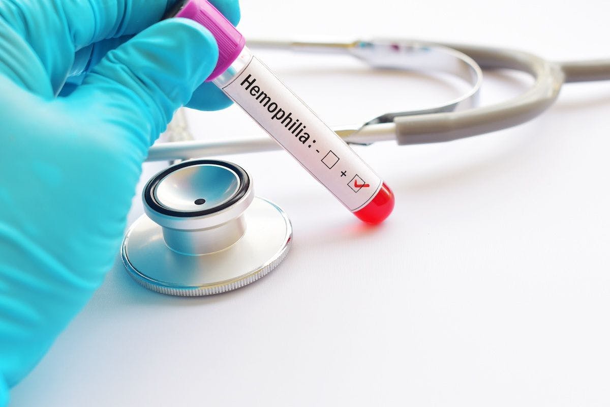 Hemophilia test | Image credit: jarun011 - stock.adobe.com
