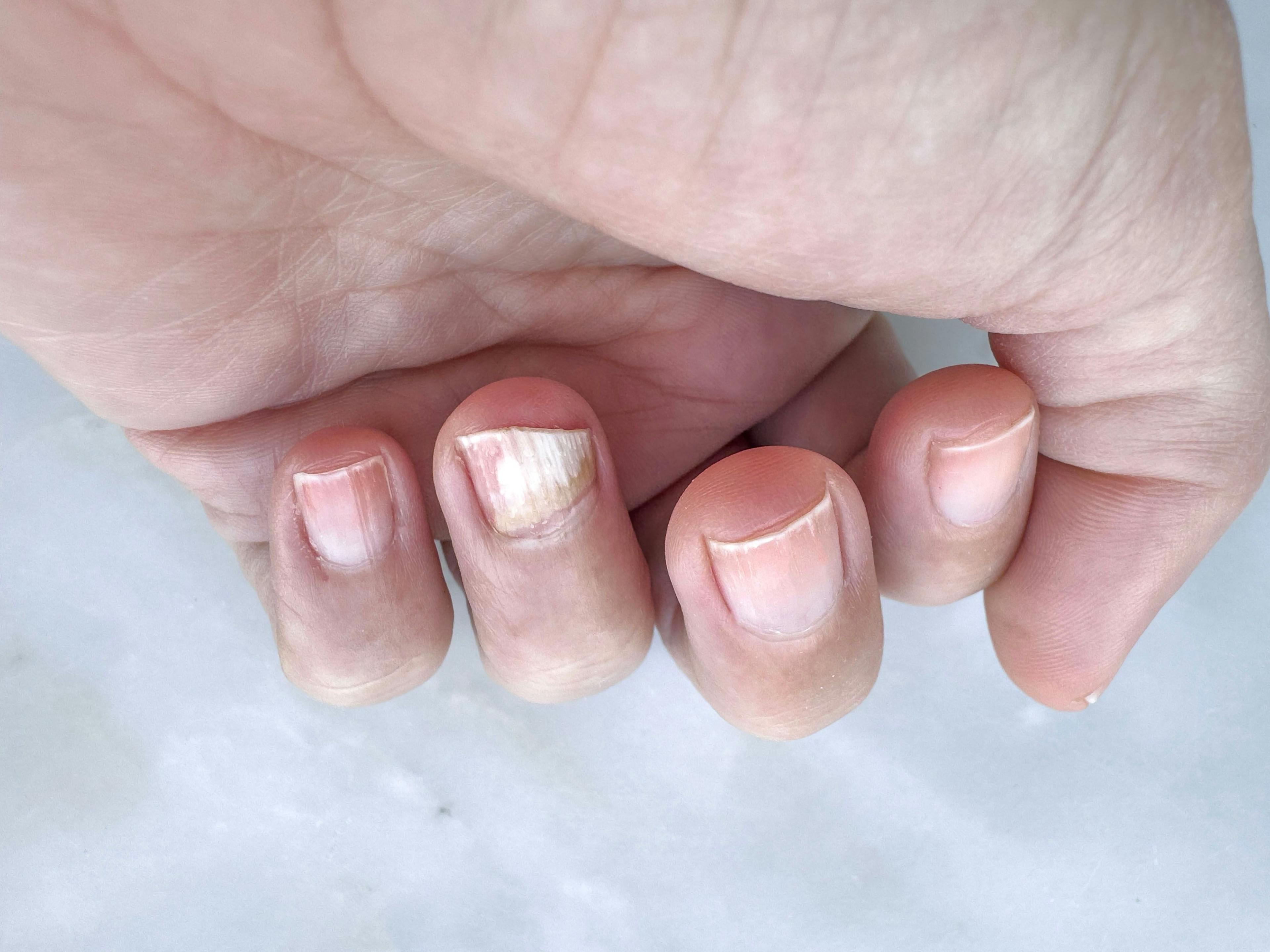 SREP protocol includes 9 pain stimuli administered to the fingernail | image credit: berna_namoglu - stock.adobe.com