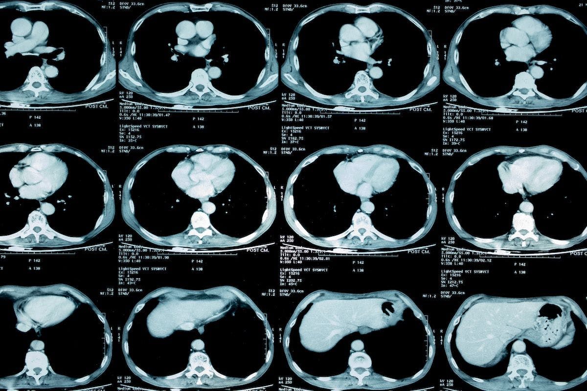 lung cancer scan | Image Credit: kae2nata-stock.adobe.com
