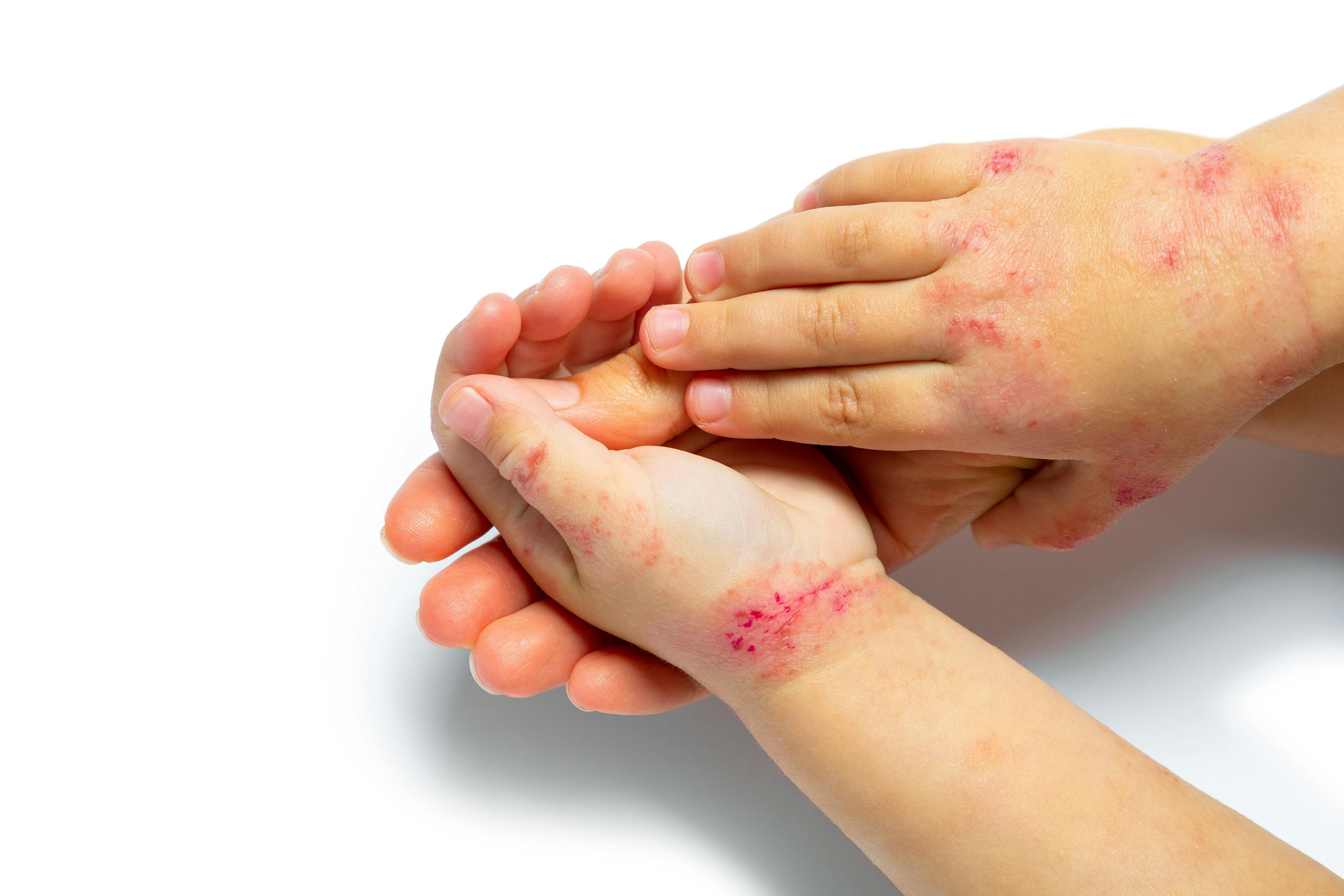 Child's hand with psoriasis | Imaged credit: Ruslan Ivantsov - stock.adobe.com