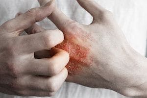 Severe Psoriasis Linked to Higher Risk of Death From Liver, Esophageal, Pancreatic Cancers