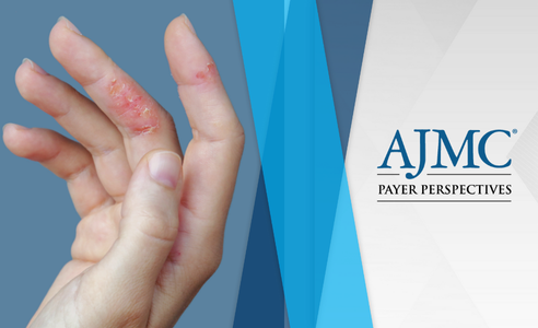 Atopic Dermatitis Payer Perspectives
