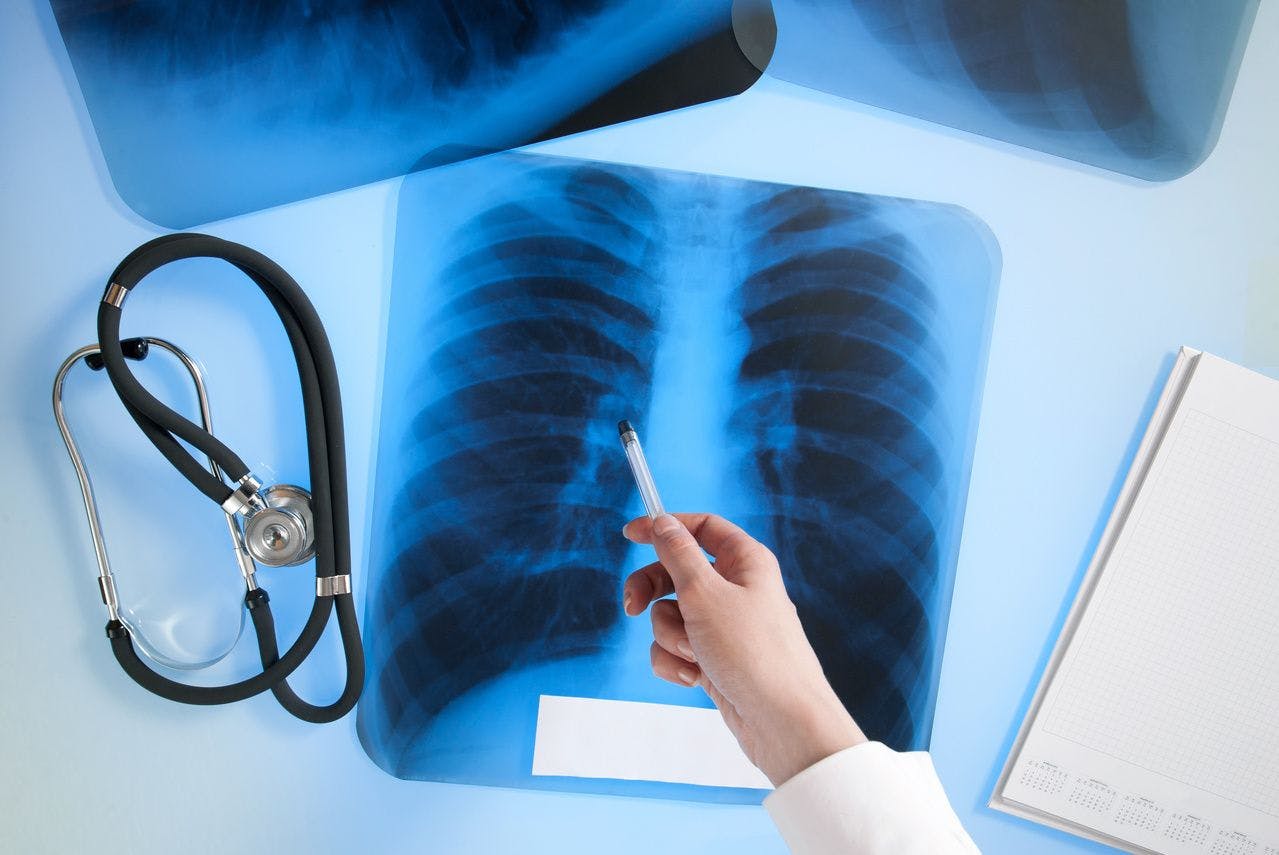 Onset of Pneumothorax Carries Poor Prognosis for Patients With CTD-ILD
