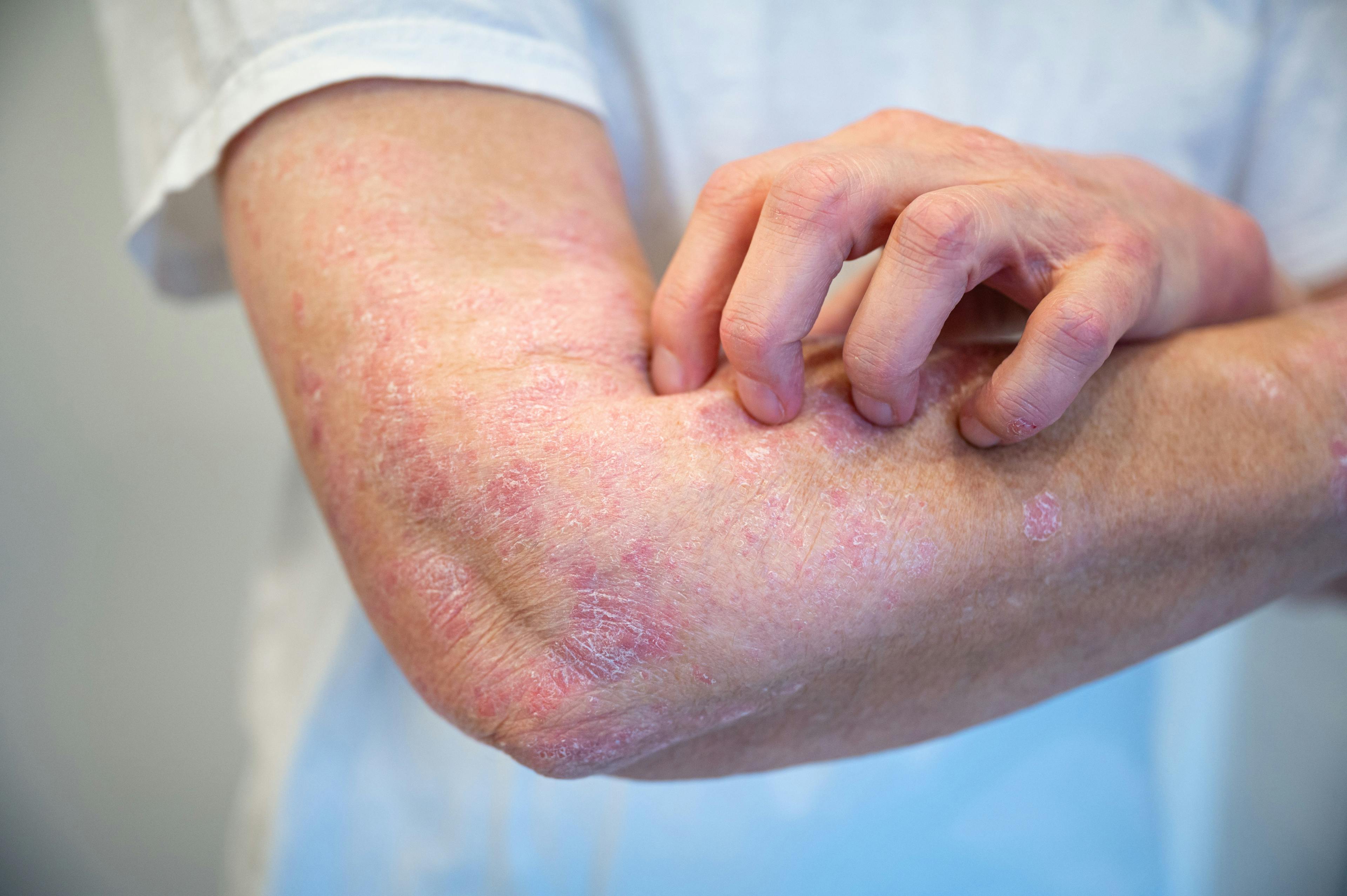 Patient with psoriasis | Image Credit: Daniel Beckemeier