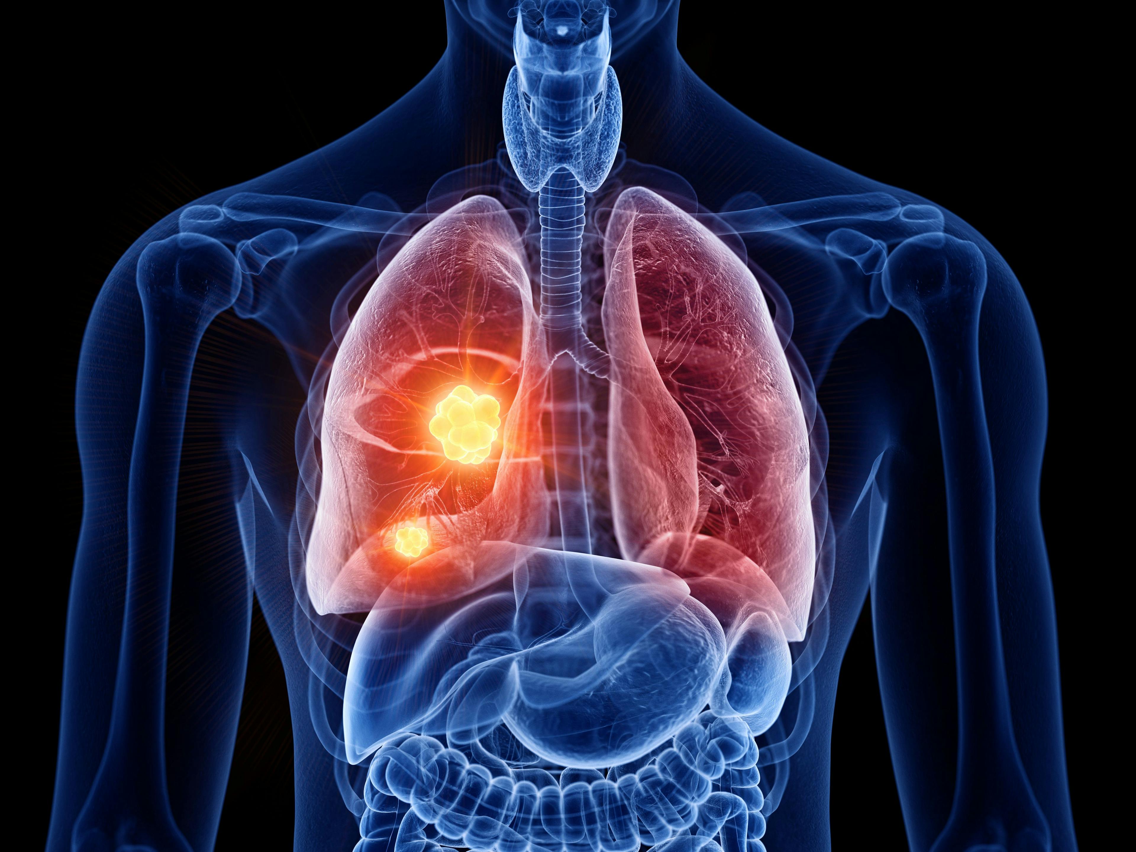 Liver-based measures of systemic inflammation can be used in determining the prognosis for a patient with NSCLC | Image credit: Sebastian Kaulitzki - stock.adobe.com