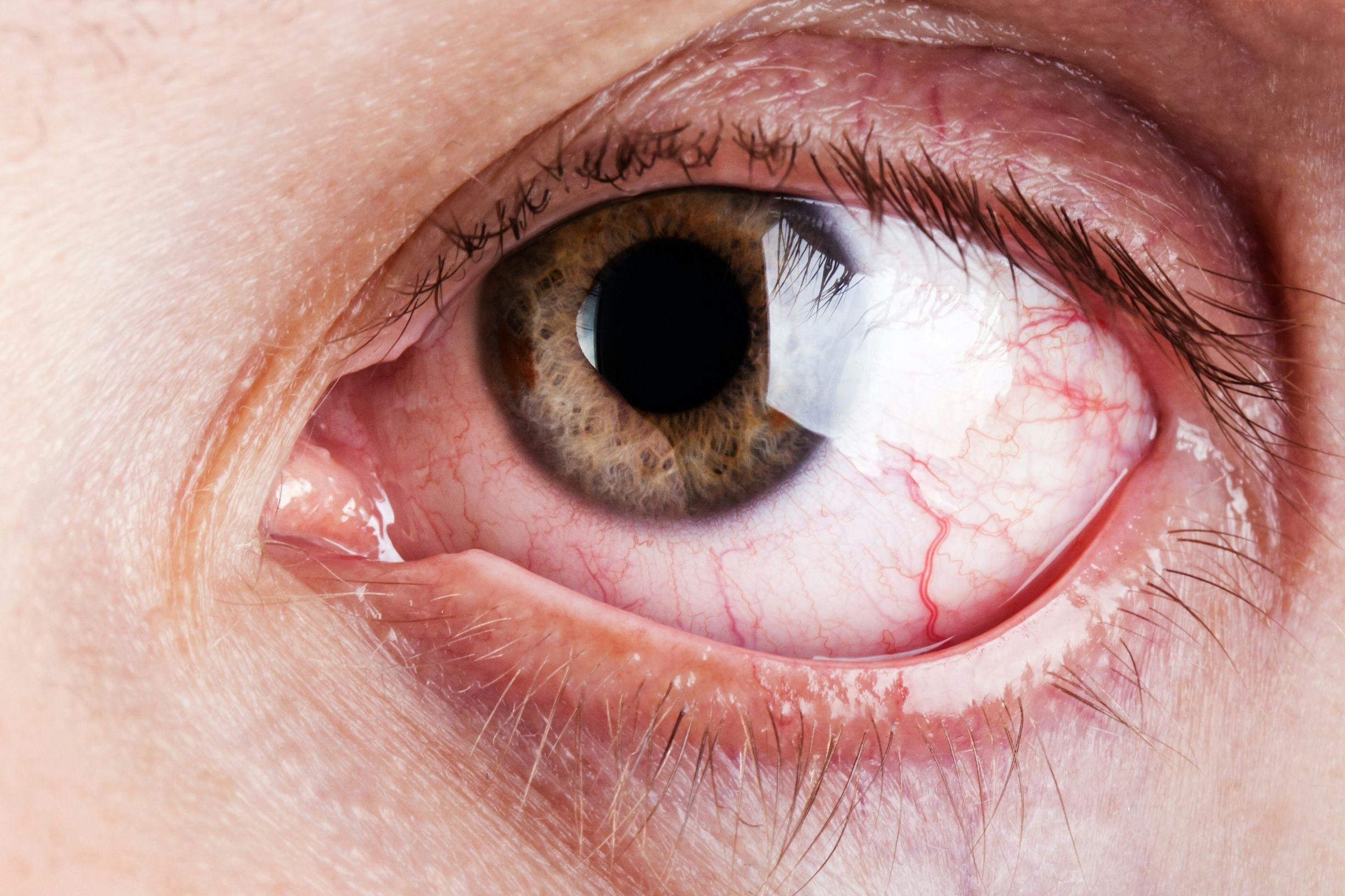 Patient with dry eye disease (DED) | Image Credit: ia_64 - stock.adobe.com