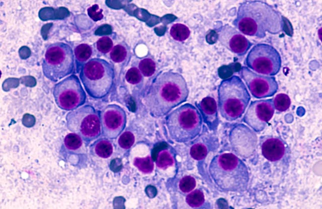 Multiple myeloma | Image Credit: © David Litman - stock.adobe.com