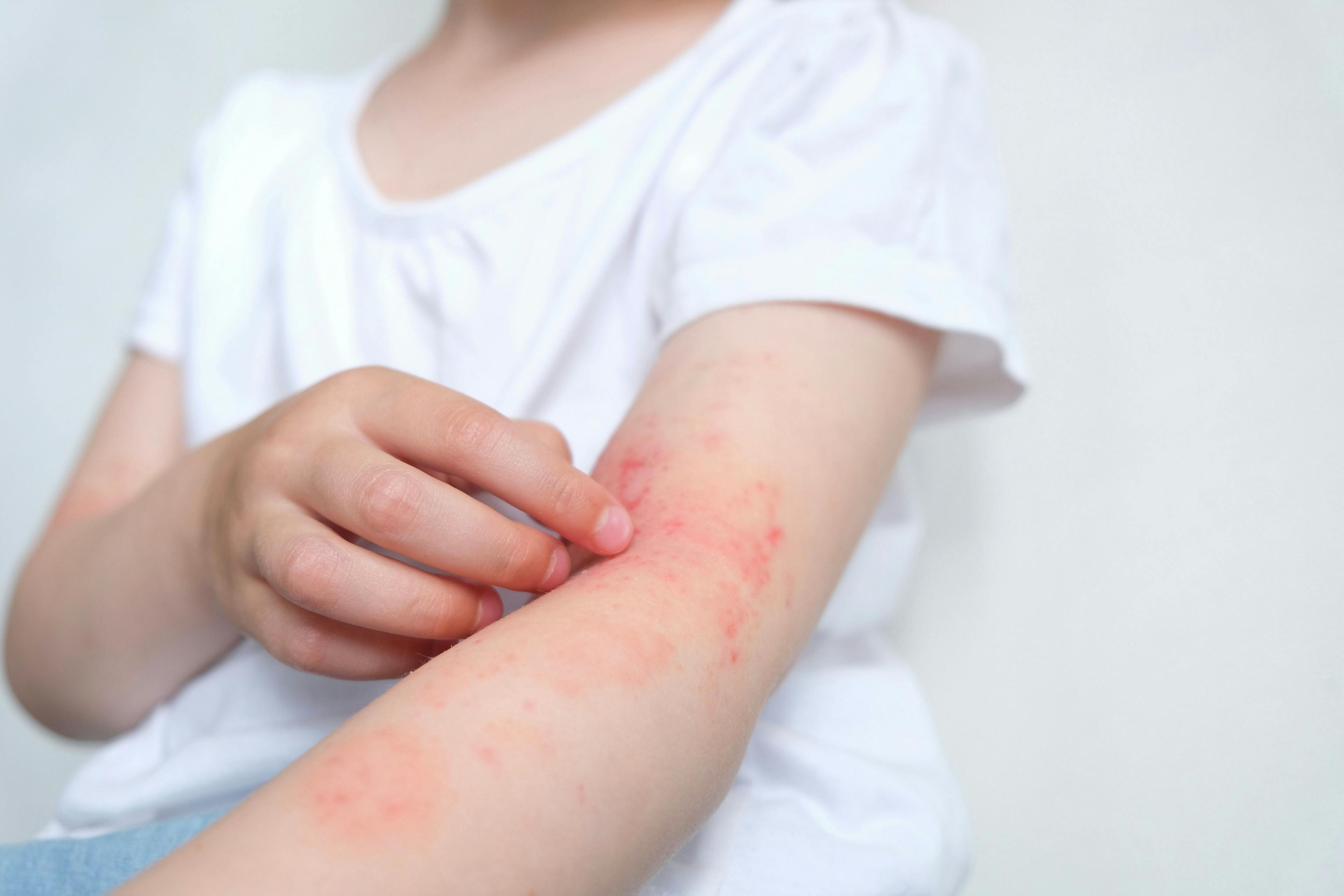 Dosage and immunosuppression should be taken into account when biologics are used for children with different skin conditions | Image credit: Марина Терехова - stock.adobe.com