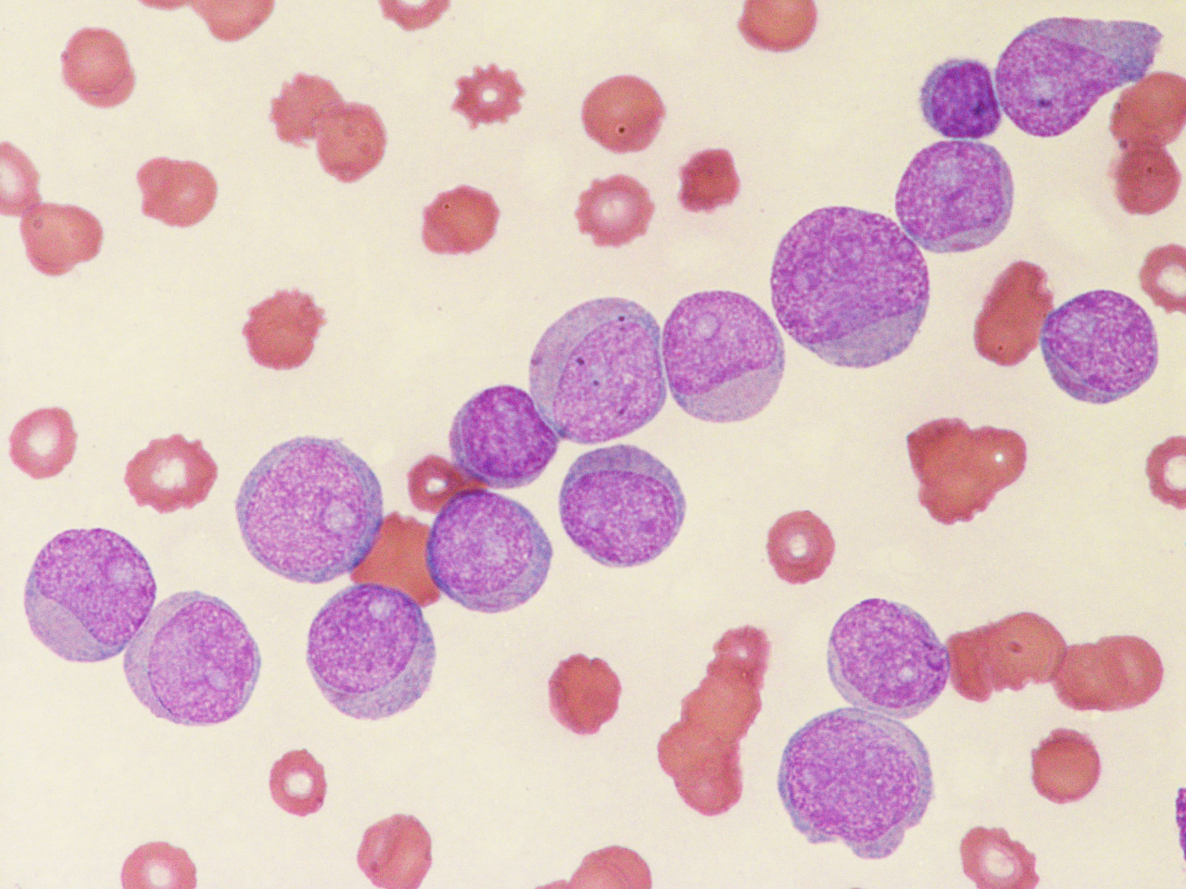 Blast cells AML | image credit: Nun22 - stock.adobe.com