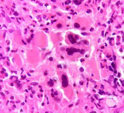 Myelofibrosis | Image credit: ASH Image bank