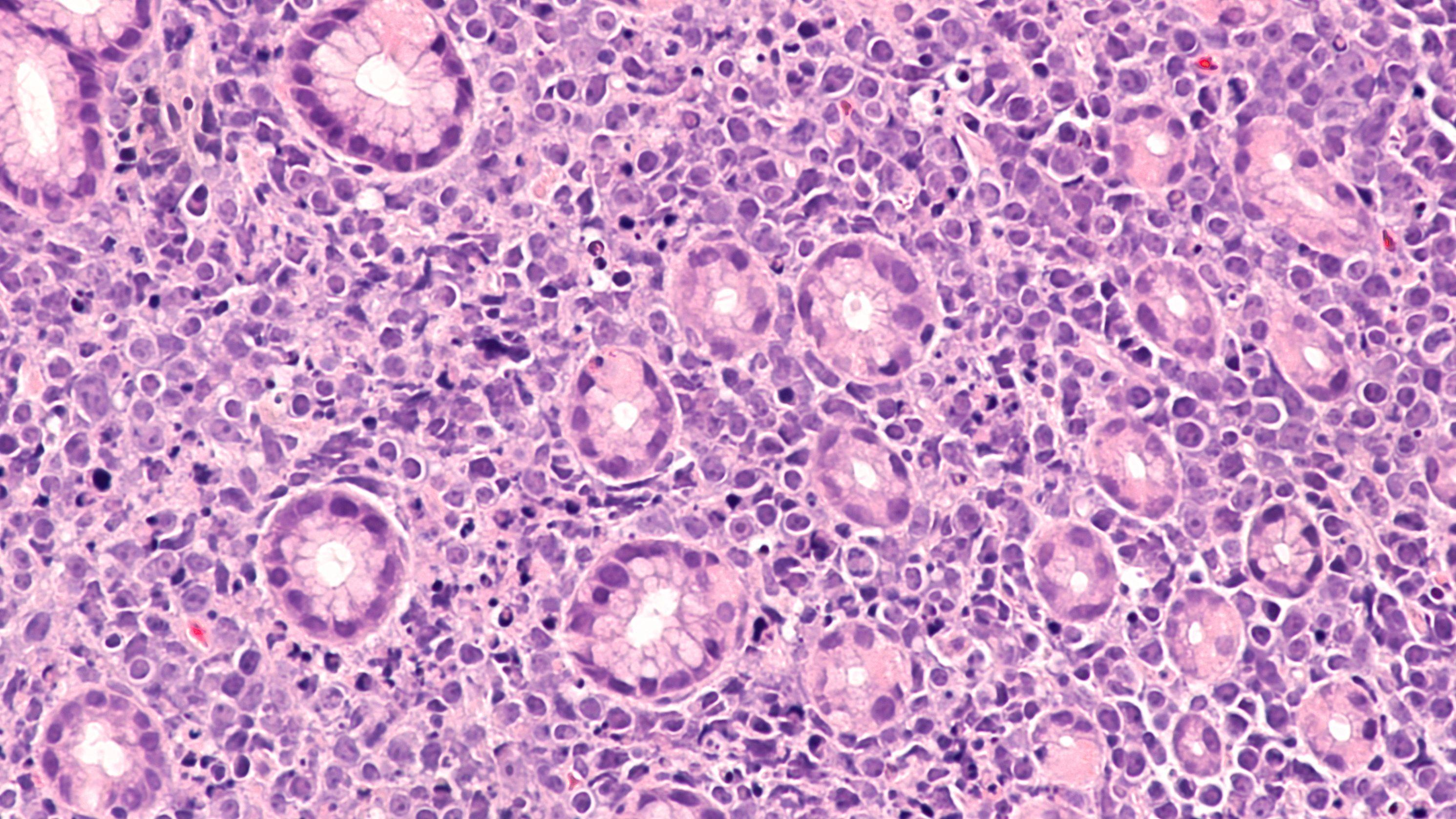 Recombinant Hirudin shows promise in the treament of DLBCL | image credit: David A Litman - stock.adobe.com