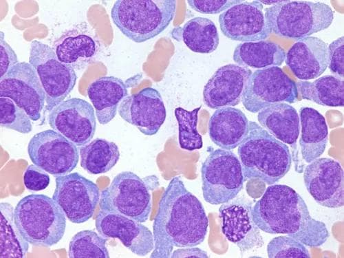 Acute myeloid leukemia | Image: St Jude Children's Research Center