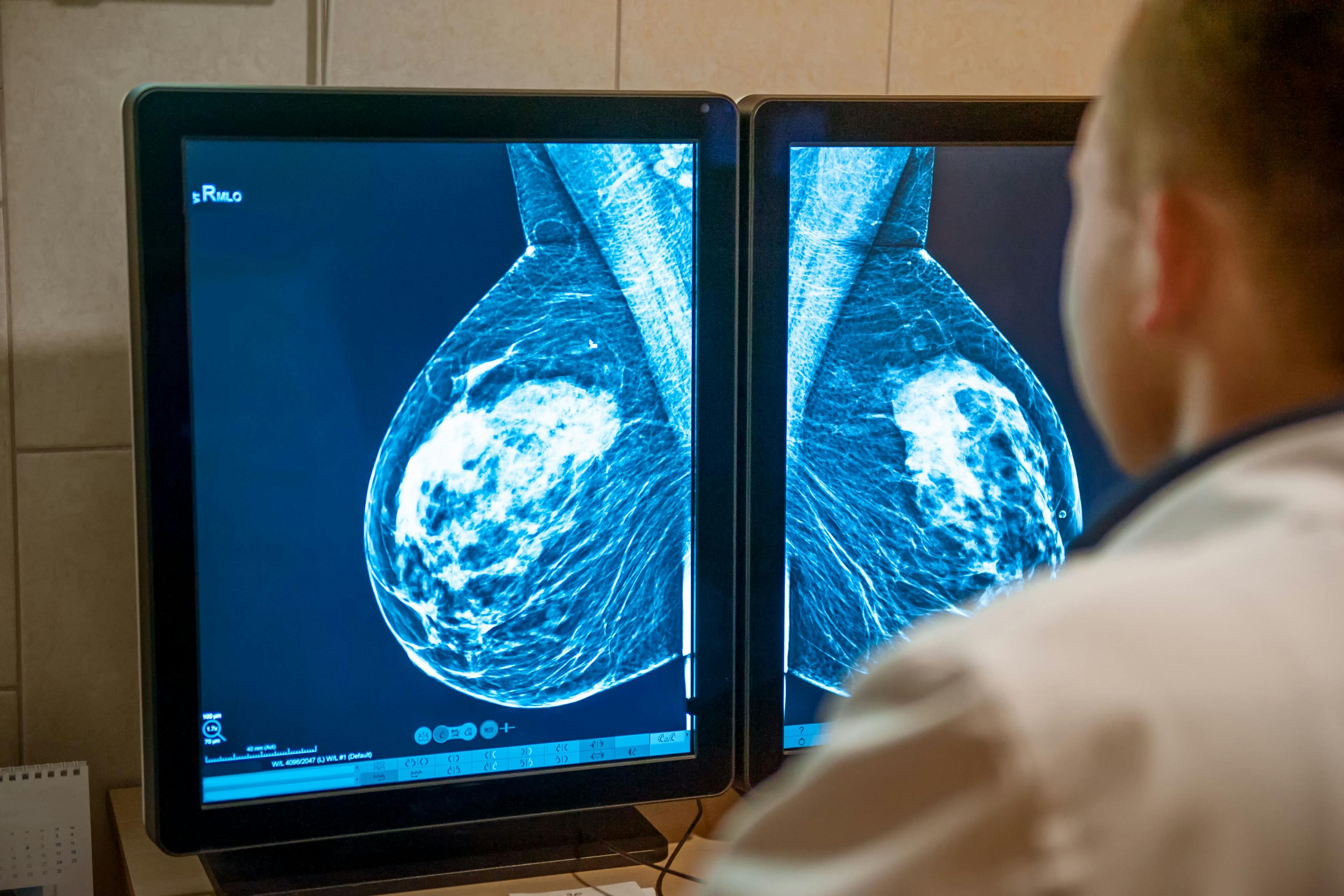 Mammogram screening | Image Credit: okrasiuk - stock.adobe.com