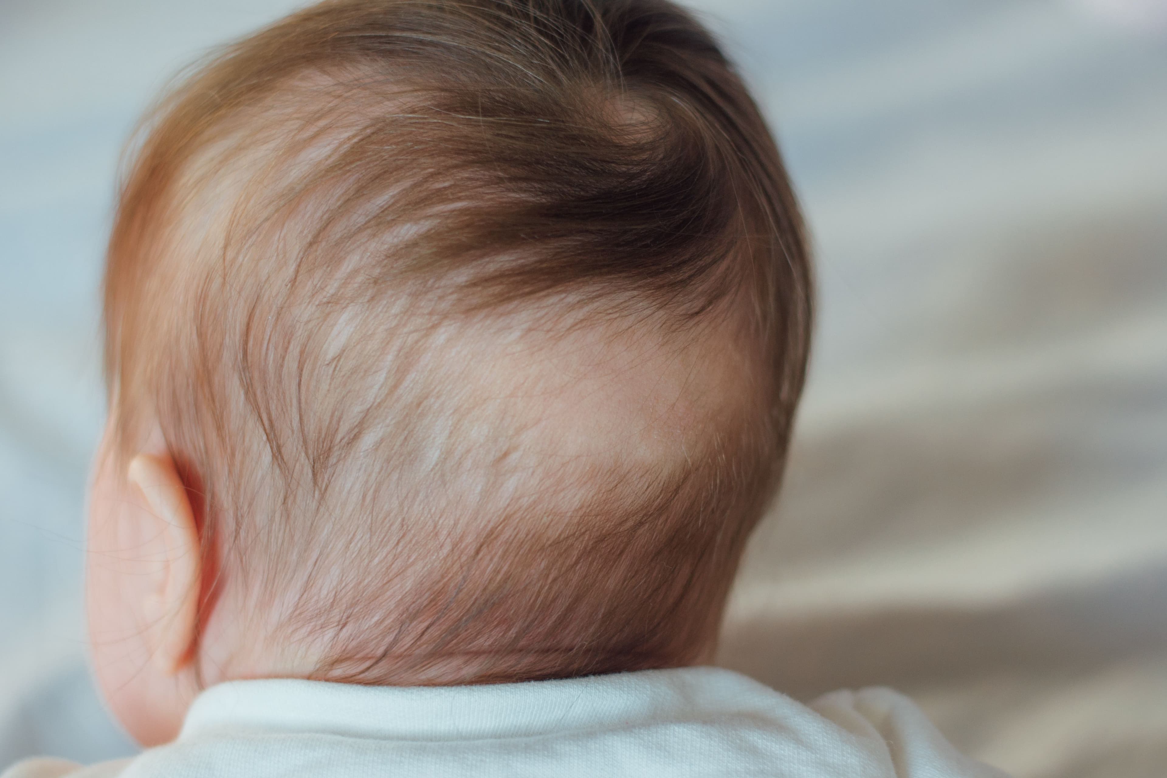 Pediatric hair loss | Image Credit:  kaloriya  - stock.adobe.com