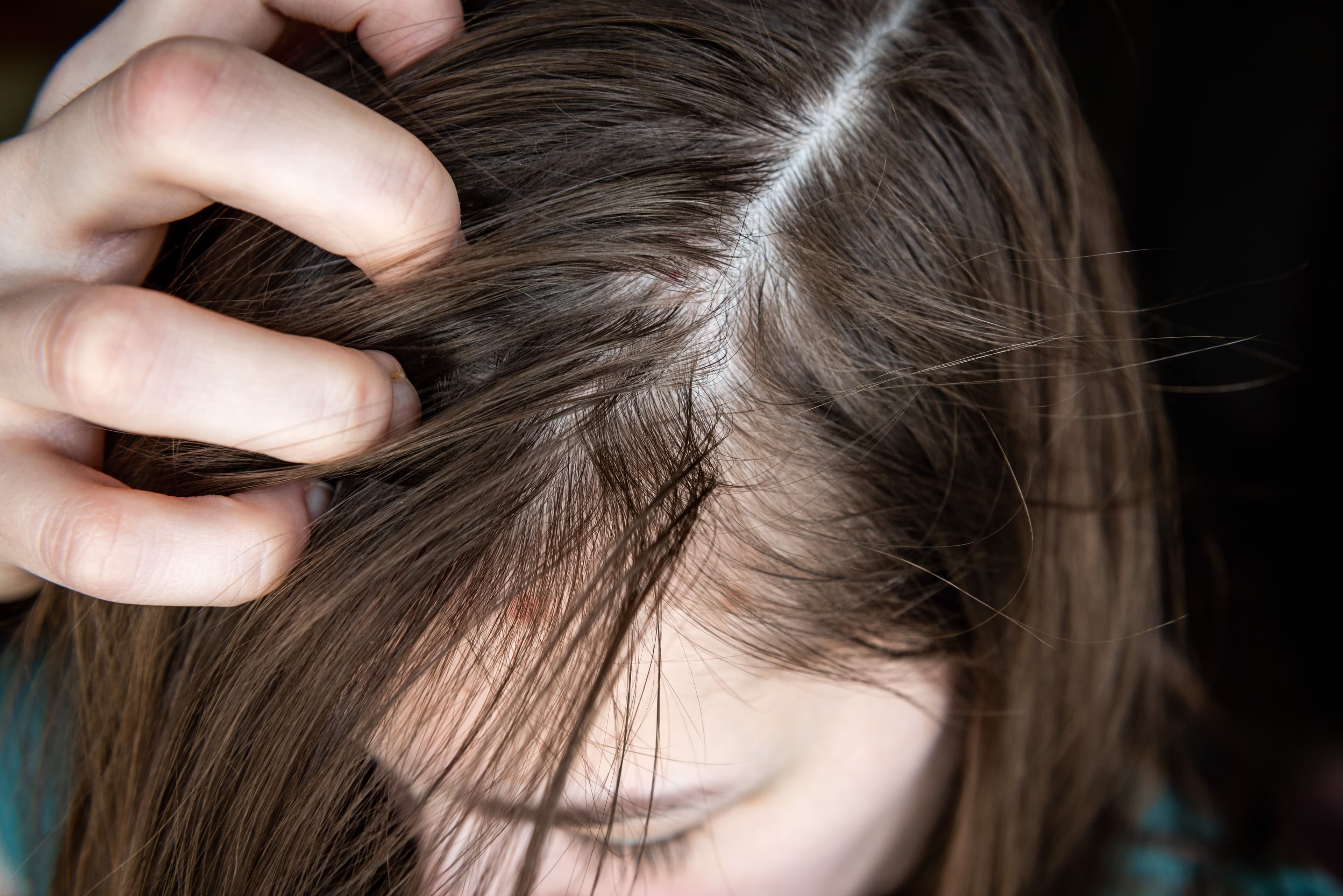 Womans hair loss | Image Credit: Natallia - stock.adobe.com