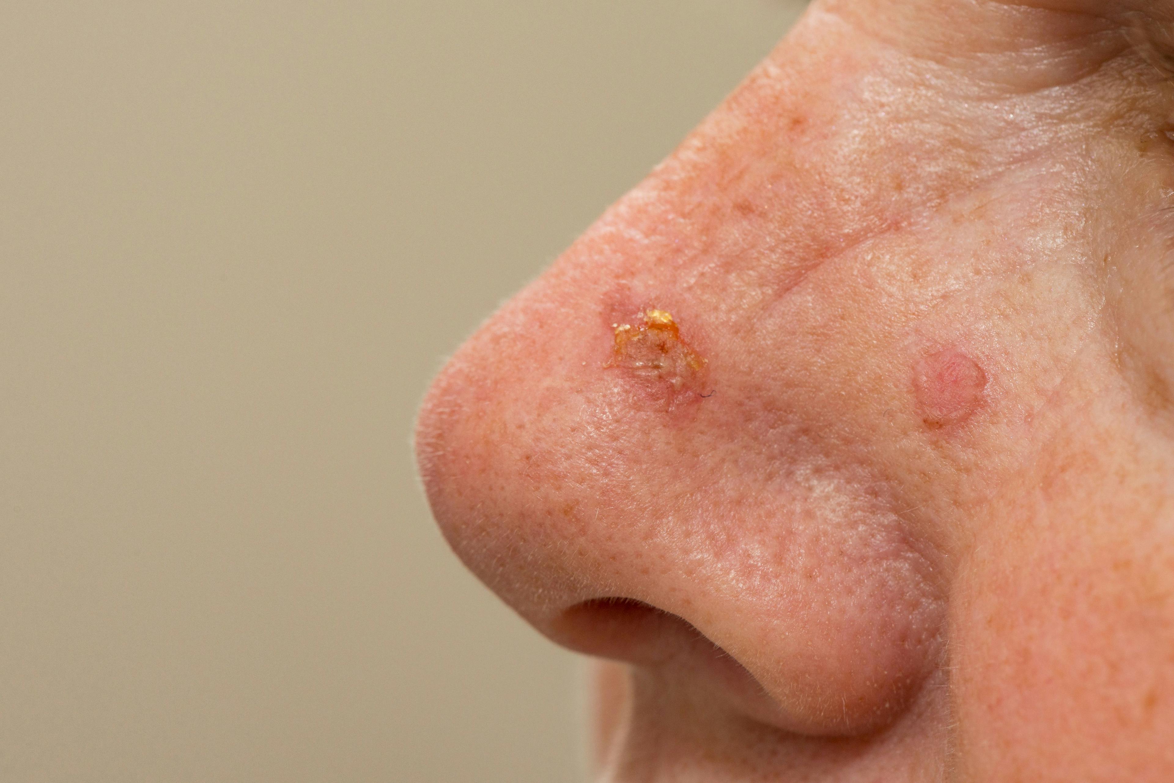 Actinic keratosis are a common precancerous skin lesion | image credit: clsdesign - stock.adobe.com