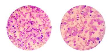 Blood smear AML | image credit: Chansom Pantip - stock.adobe.com