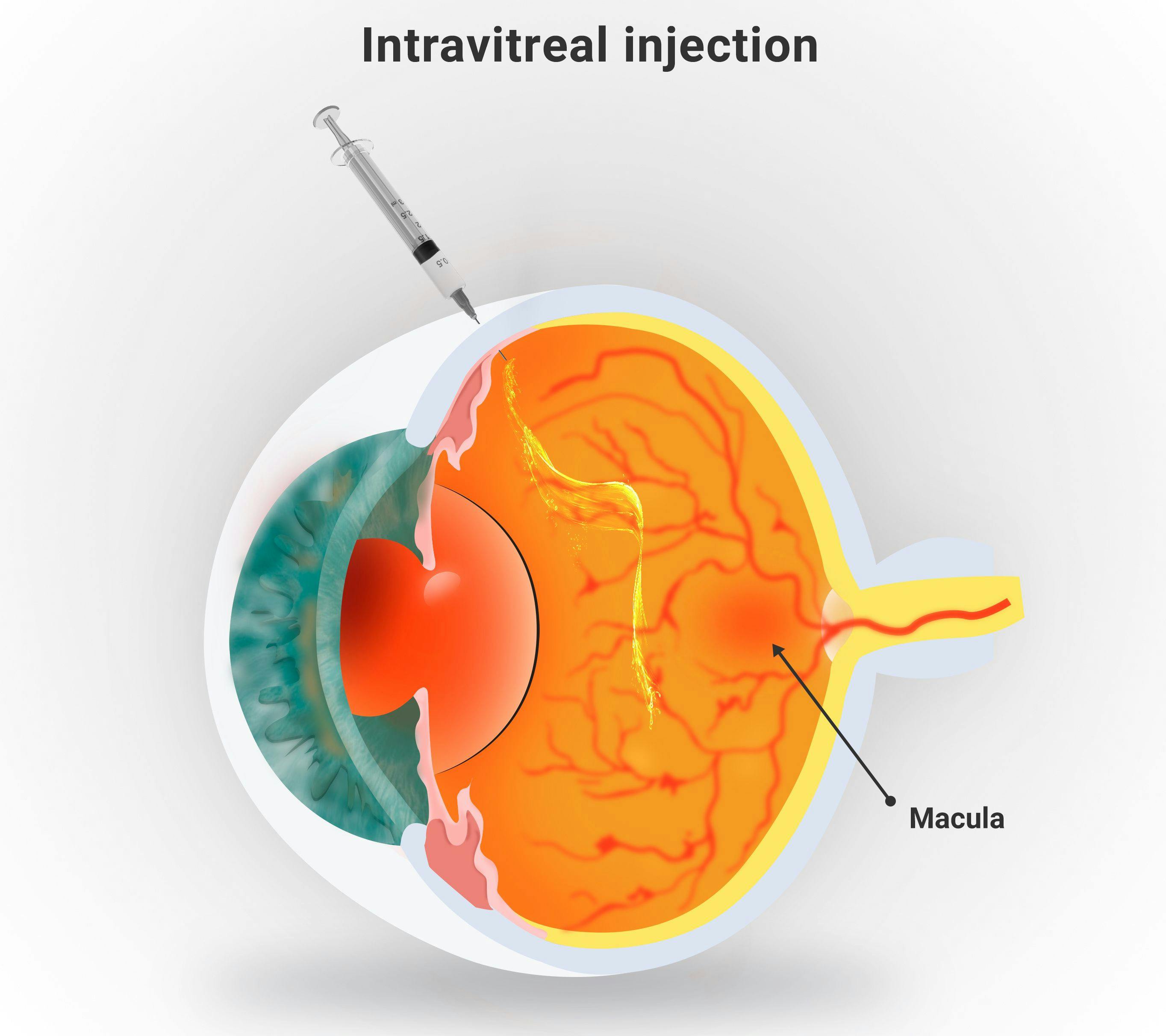 Intravitreal injection | Image credit: AngeloSouza - stock.adobe.com