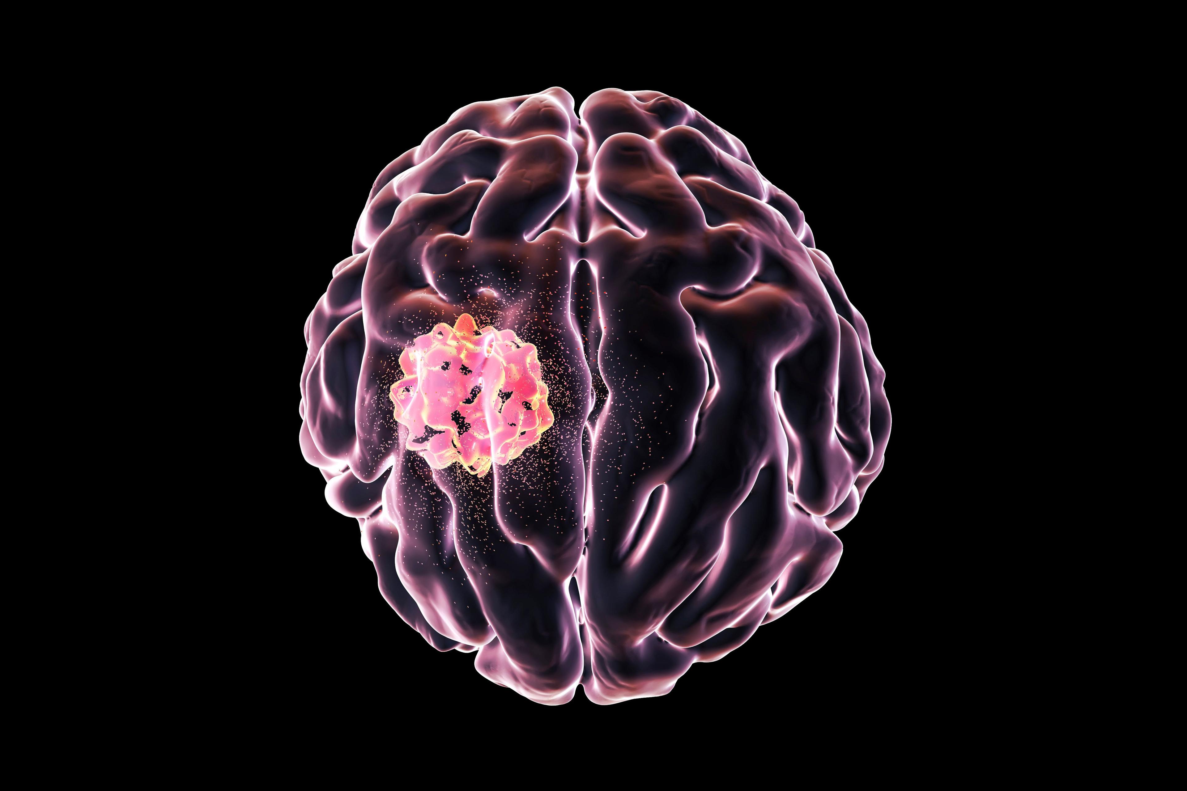 Brain tumor 3D illustration | Imaged credit: Dr_Microbe - stock.adobe.com