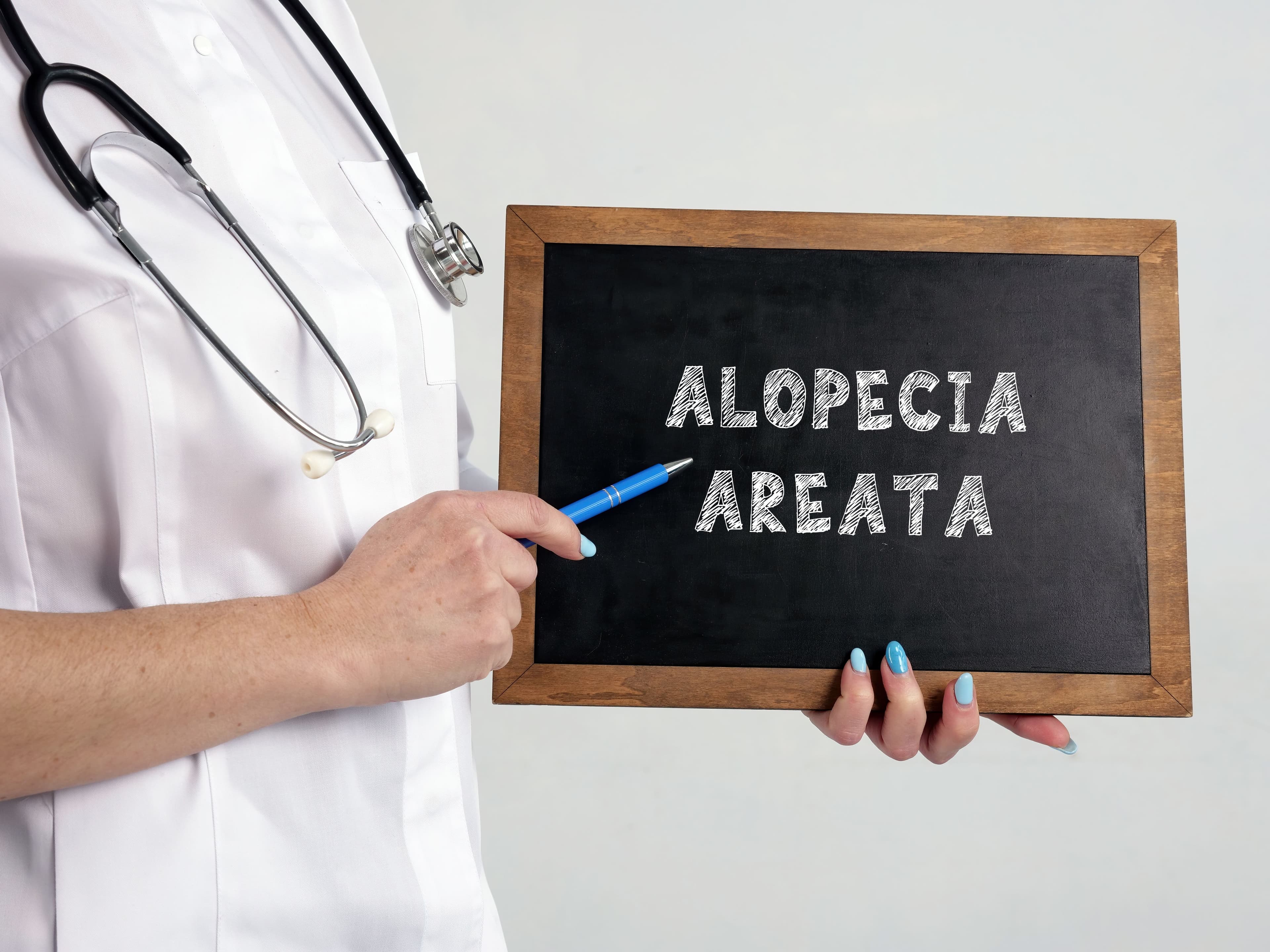 Alopecia Areata. | Image Credit: Yurii Kibalnik - stock.adobe.com