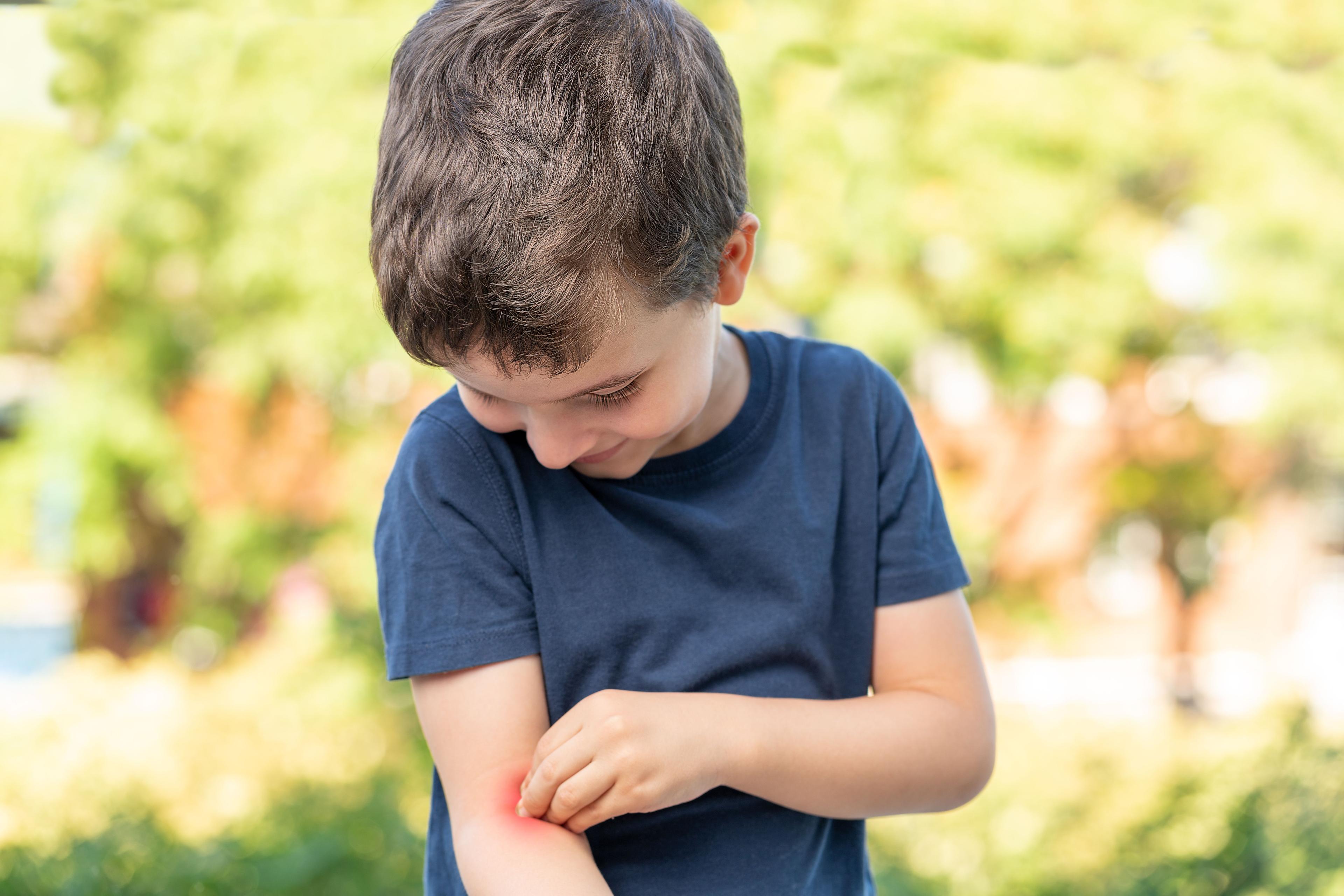 Child scratching arm | Image credit: cunaplus - stock.adobe.com