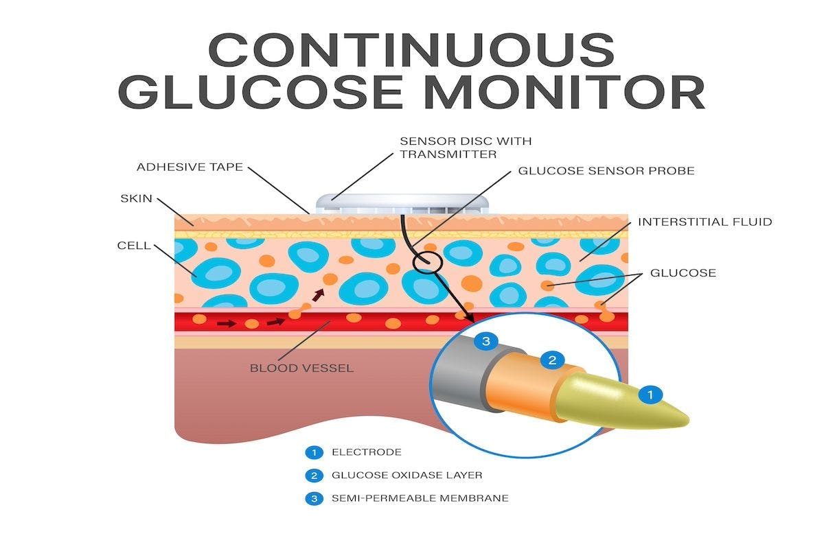 Continuous glucose monitor | Image Credit:Pro_Victor-stock.adobe.com
