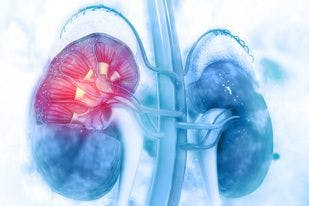 Amyloidosis Linked to Lower Long-term Survival Following Kidney Transplant