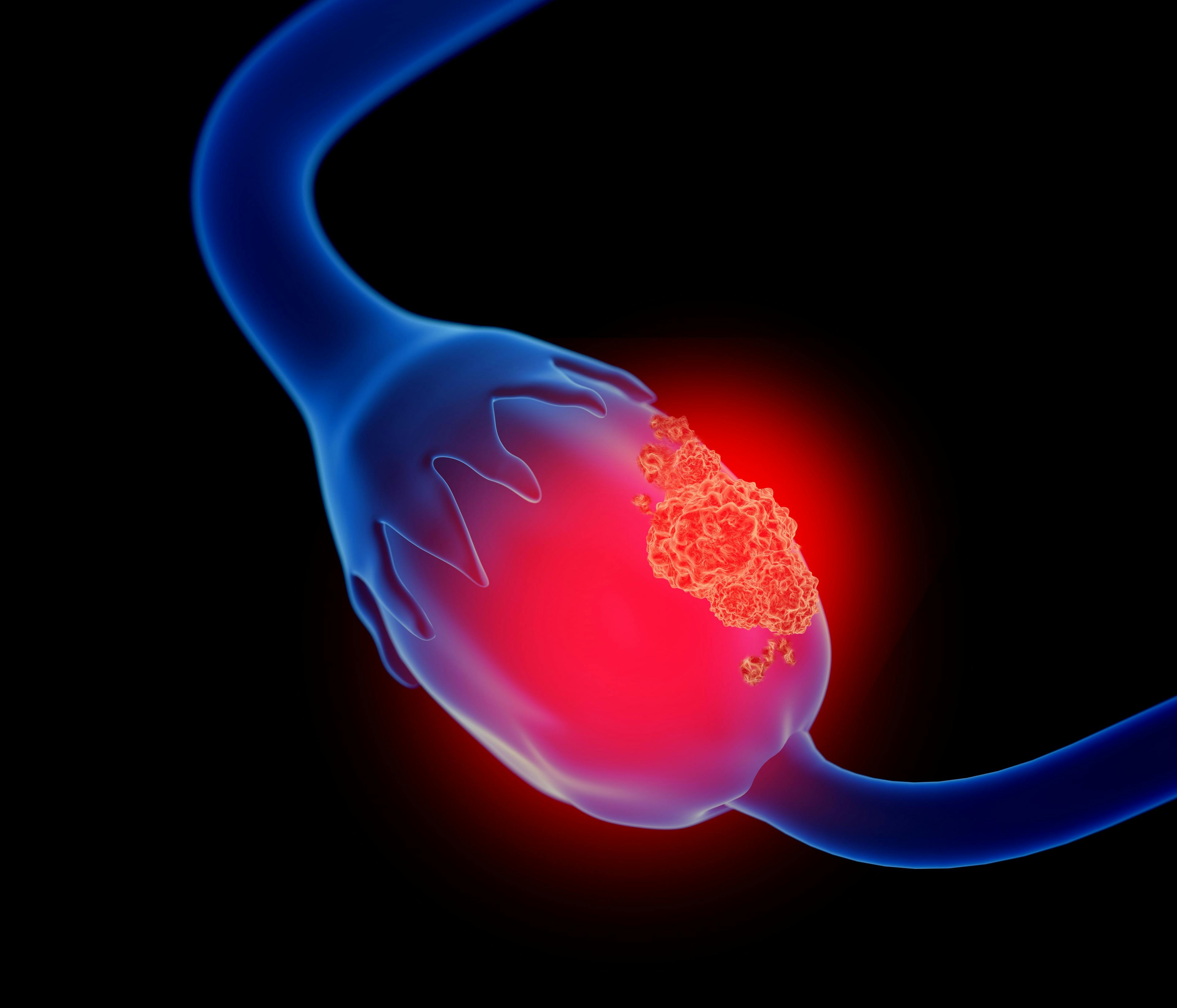 Ovarian cancer recurrence occurs in approximately 70% of cases | Image credit: Lars Neumann - stock.adobe.com