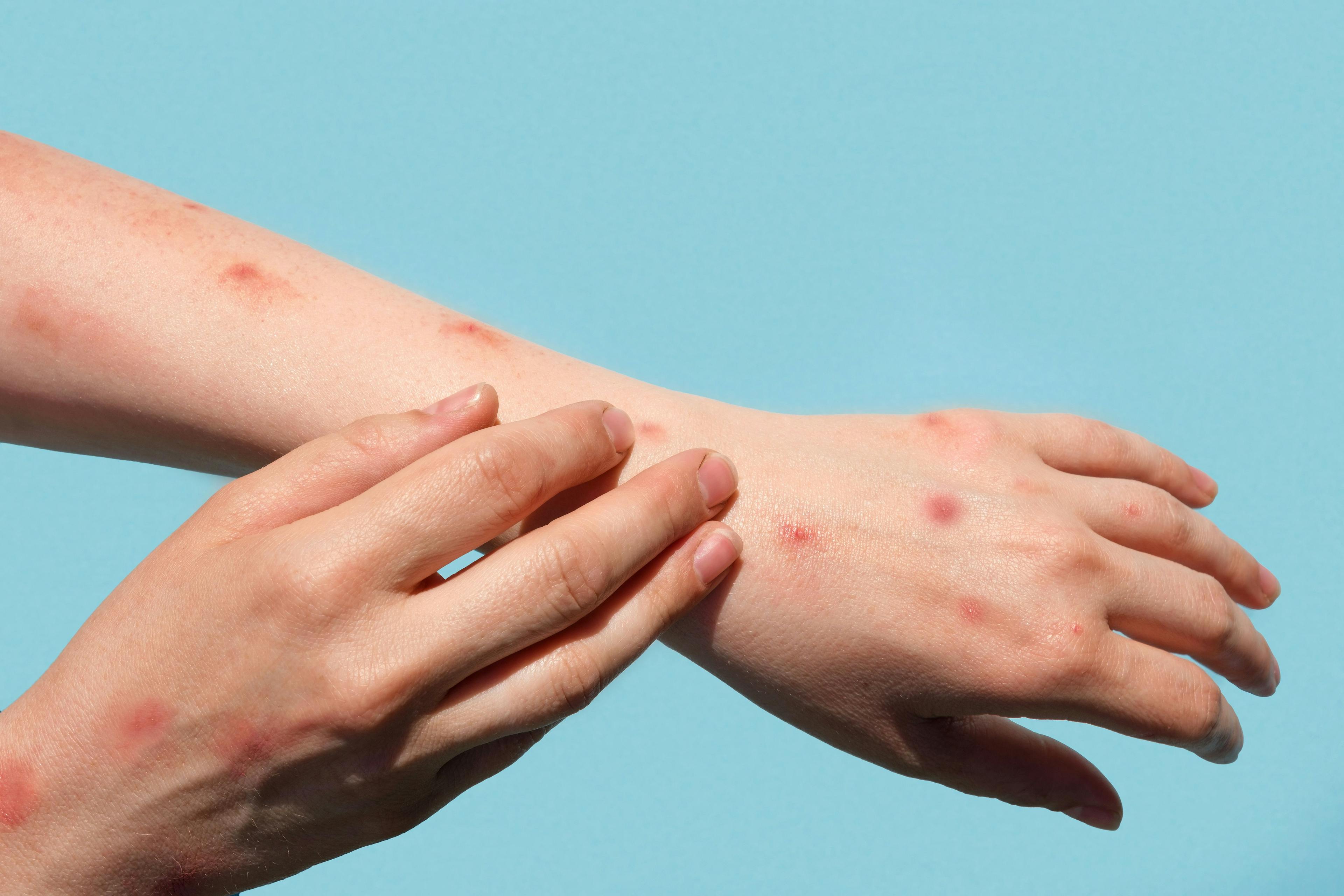 Mpox rashes may contain anywhere from 1 to hundreds of lesions, or more | image credit: Marina Demidiuk - stock.adobe.com