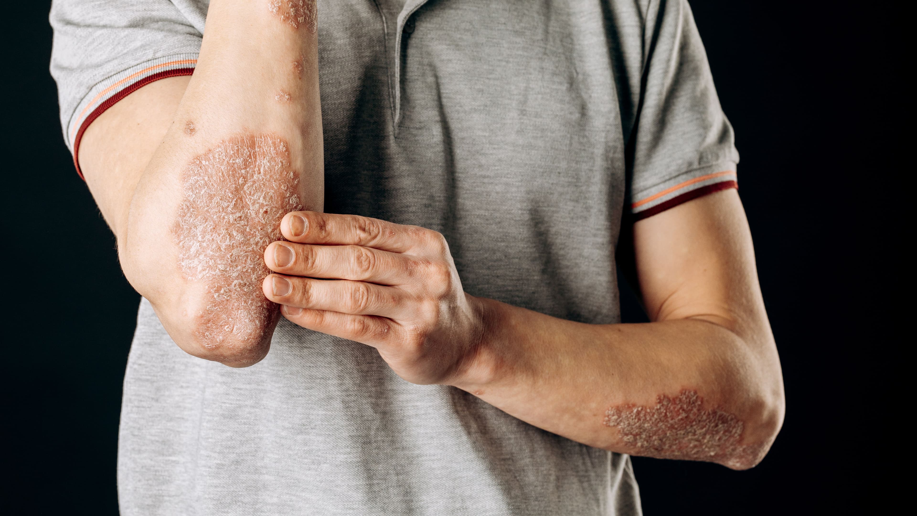 psoriasis on a white man | Image credit: fusssergei - stock.adobe.com