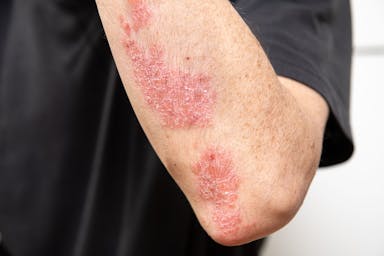 Psoriasis | image credit: pimentos – stock.adobe.com.jpg