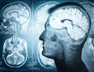 Examining the Link Between Cerebral Small-Vessel Diseases and Motor Symptoms in Parkinson Disease