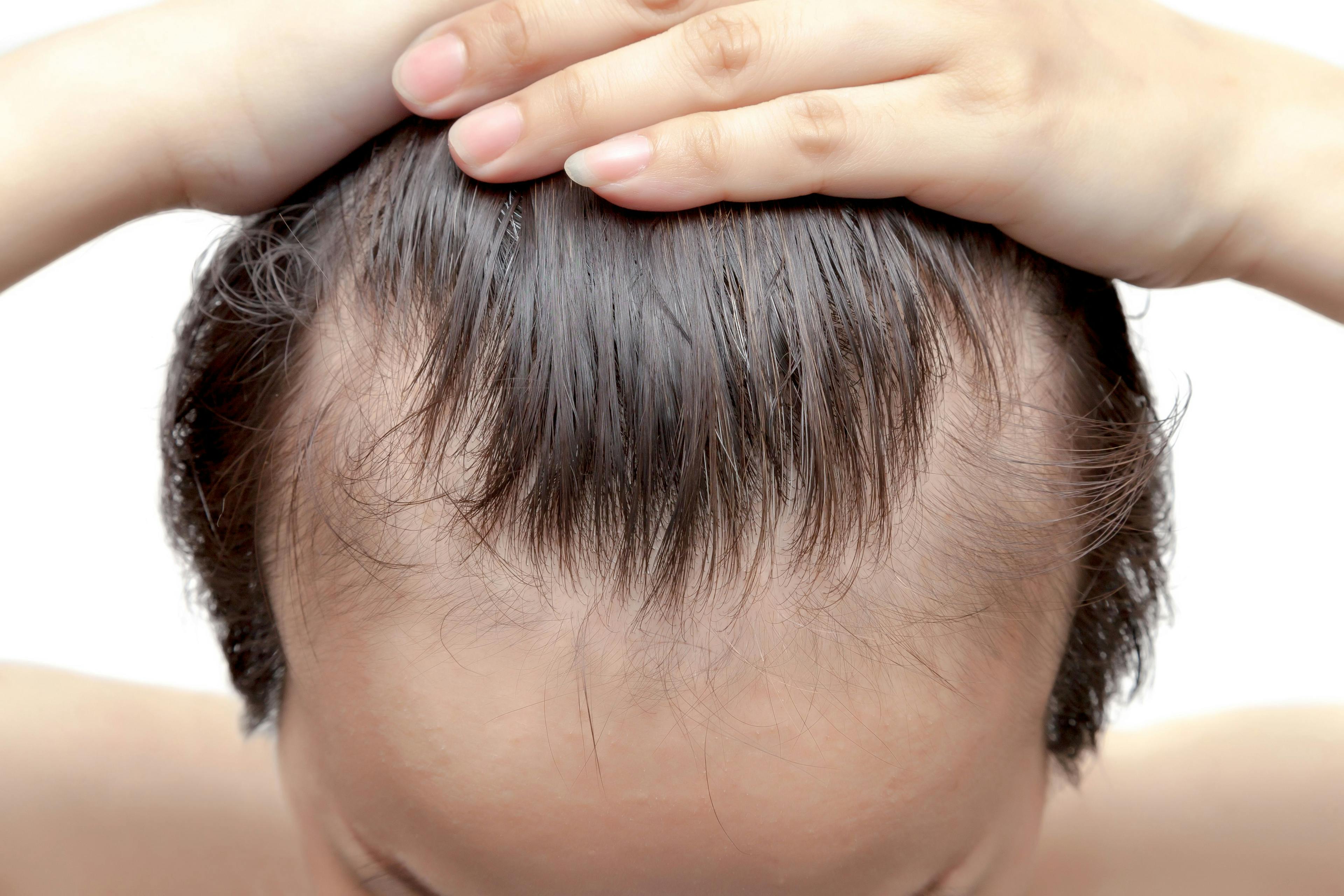 Receding hair line | Image Credit: Bongkochrut - stock.adobe.com