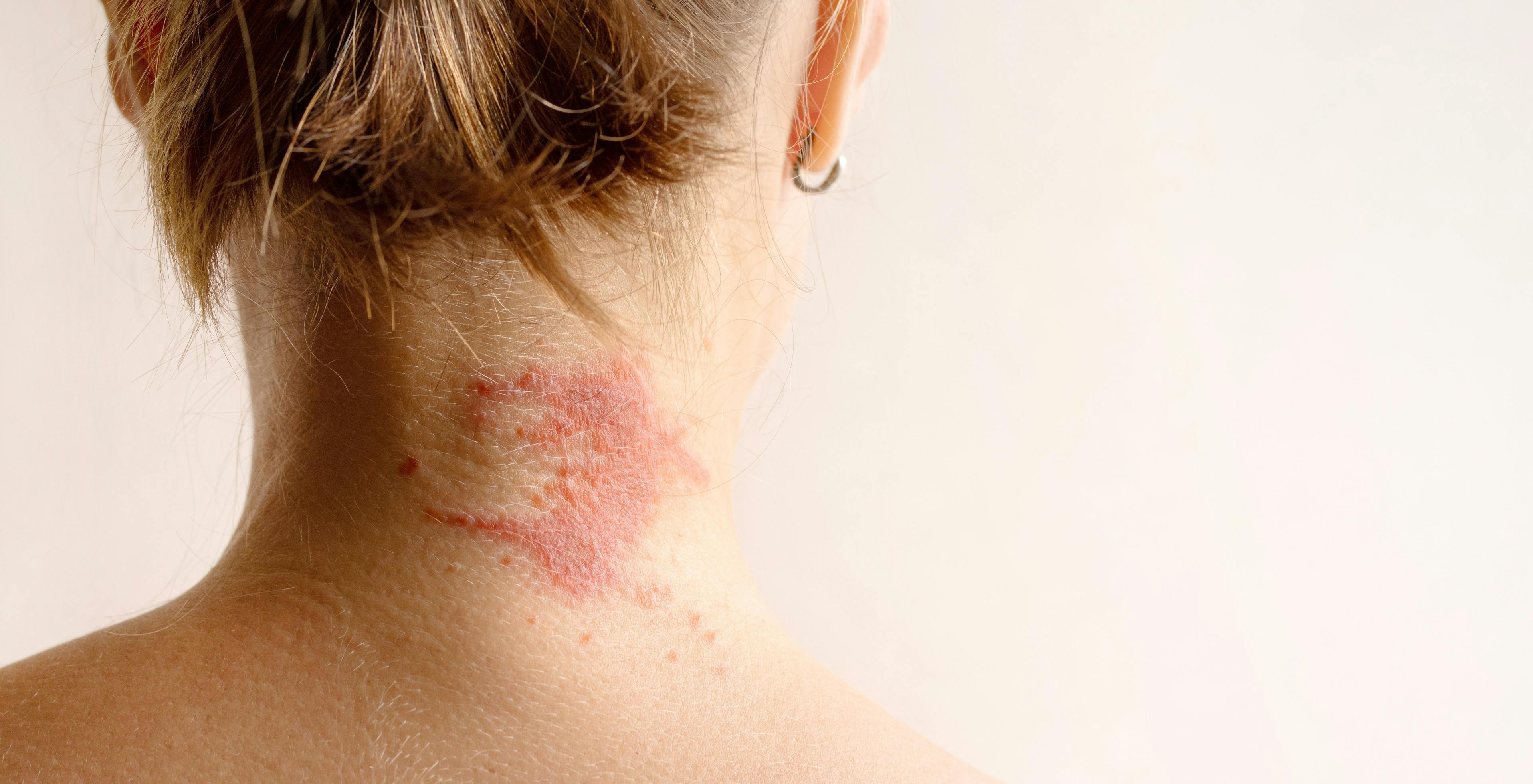 Female patient with atopic dermatitis (AD) on the back of her neck | Image Credit: isavira - stock.adobe.comFemale patient with atopic dermatitis (AD) on the back of her neck | Image Credit: isavira - stock.adobe.comFemale patient with atopic dermatitis (AD) on the back of her neck | Image Credit: isavira - stock.adobe.comFemale patient with atopic dermatitis (AD) on the back of her neck | Image Credit: isavira - stock.adobe.comFemale patient with atopic dermatitis (AD) on the back of her neck | Image Credit: isavira - stock.adobe.comFemale patient with atopic dermatitis (AD) on the back of her neck | Image Credit: isavira - stock.adobe.comFemale patient with atopic dermatitis (AD) on the back of her neck | Image Credit: isavira - stock.adobe.com