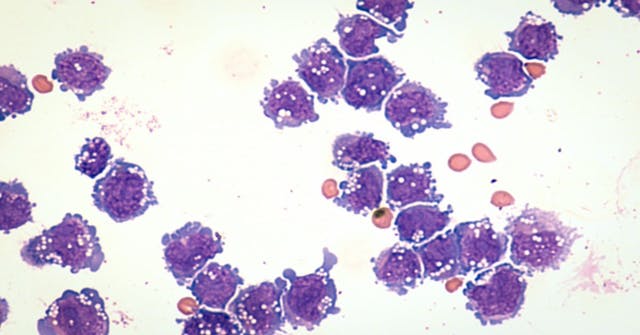 microscopic image of DLBCL | Image Credit: David A Litman-stock.adobe.com