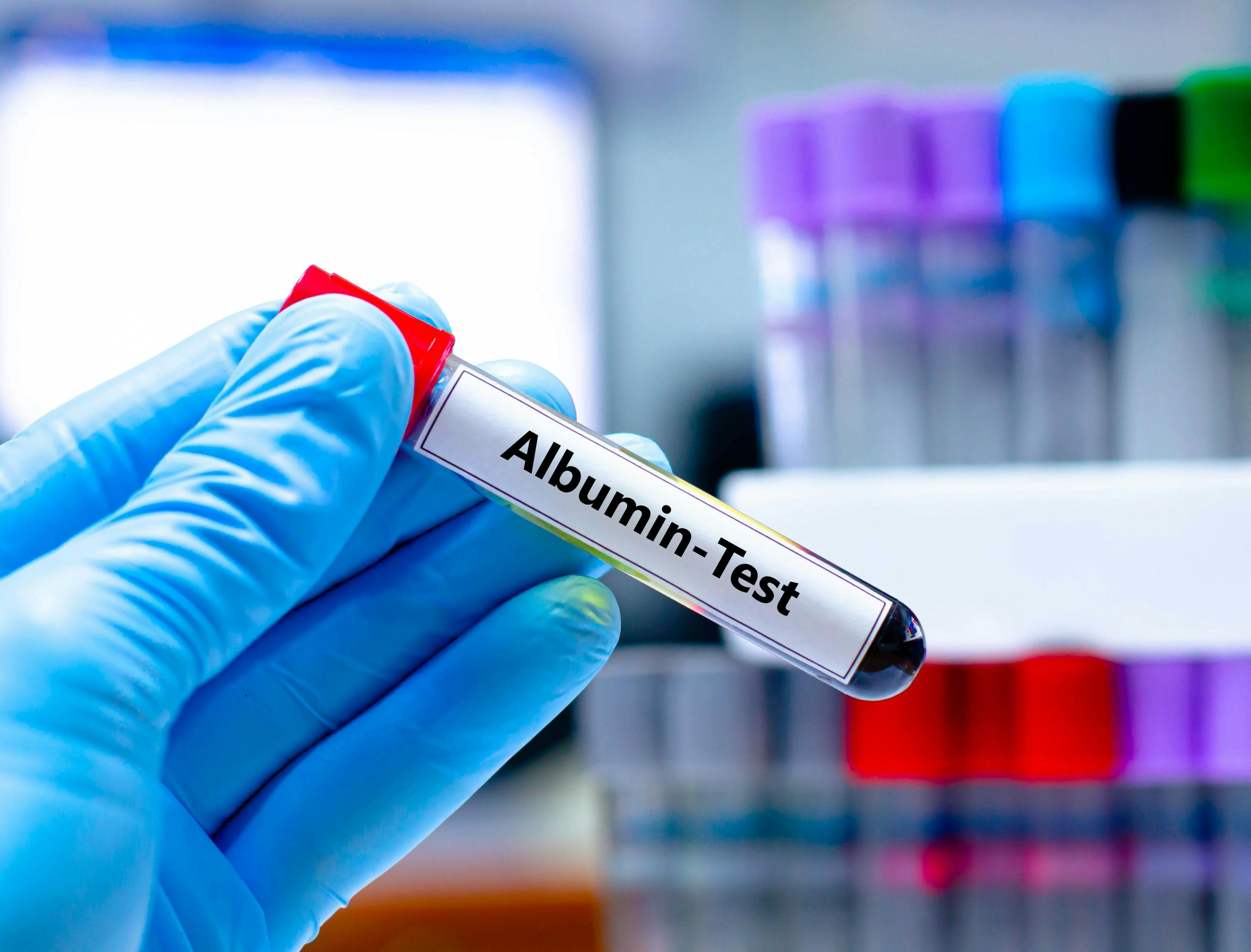 Albumin is the most abundant protein in the blood | Image Credit: kitsawet - stock.adobe.com