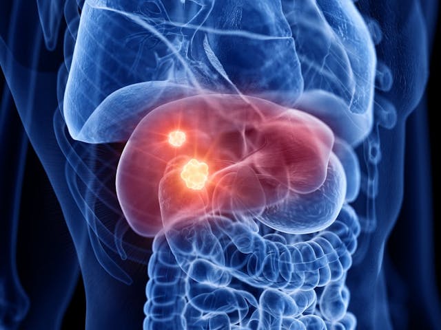 Illustration of liver cancer | Image credit: Sebastian Kaulitzki - stock.adobe.com