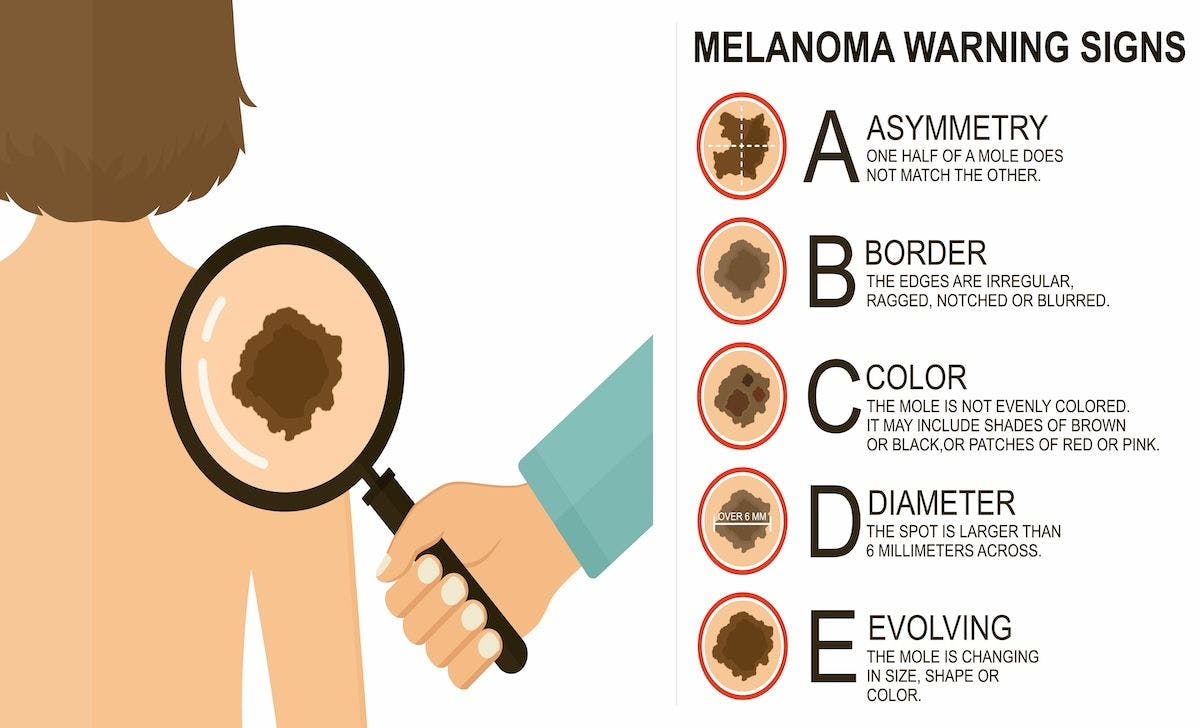 Melanoma | Image Credit: alena-stock.adobe.com